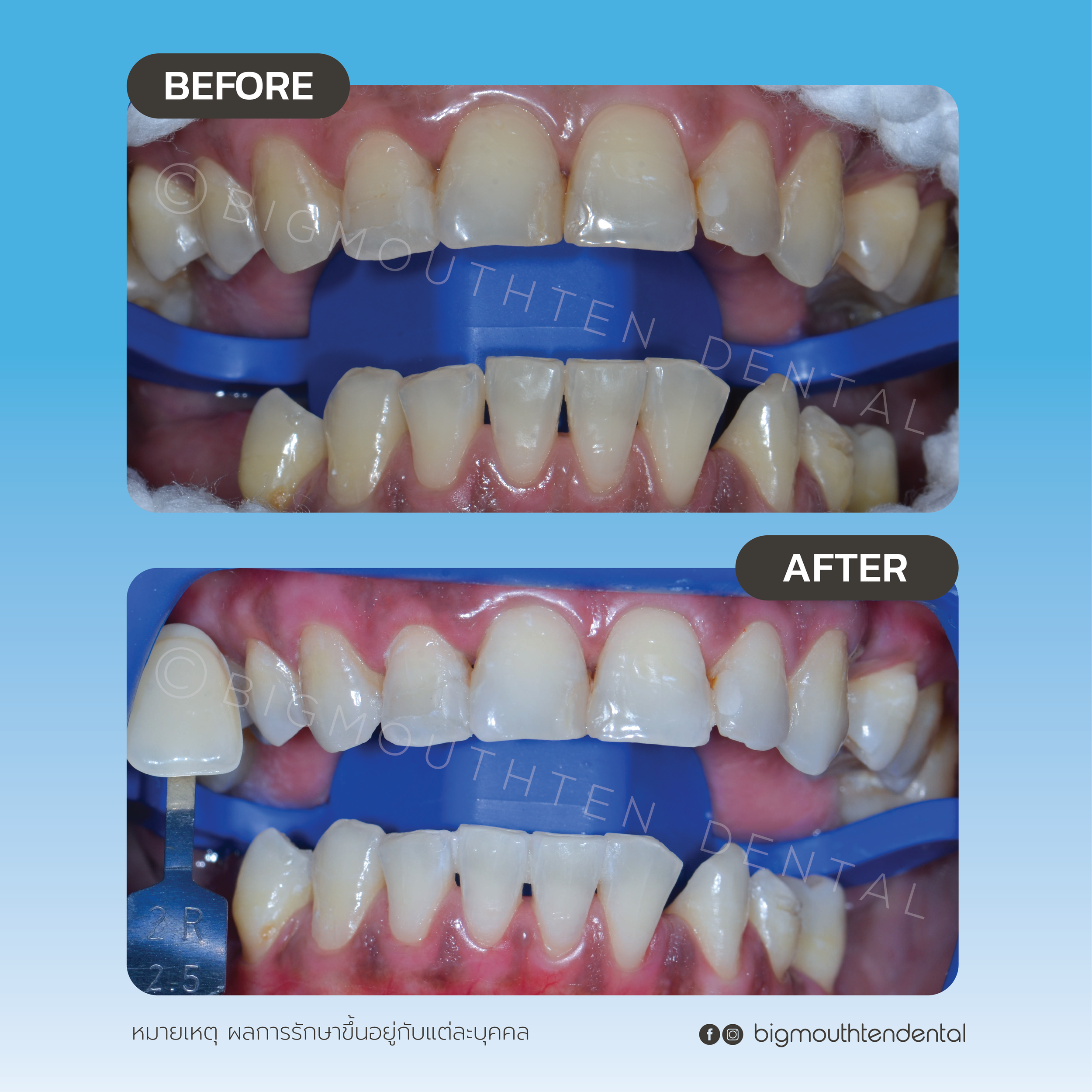 รีวิวเคสฟอกสีฟันที่คลินิก before after ฟอกสีฟัน Zoom  เชียงใหม่ 
