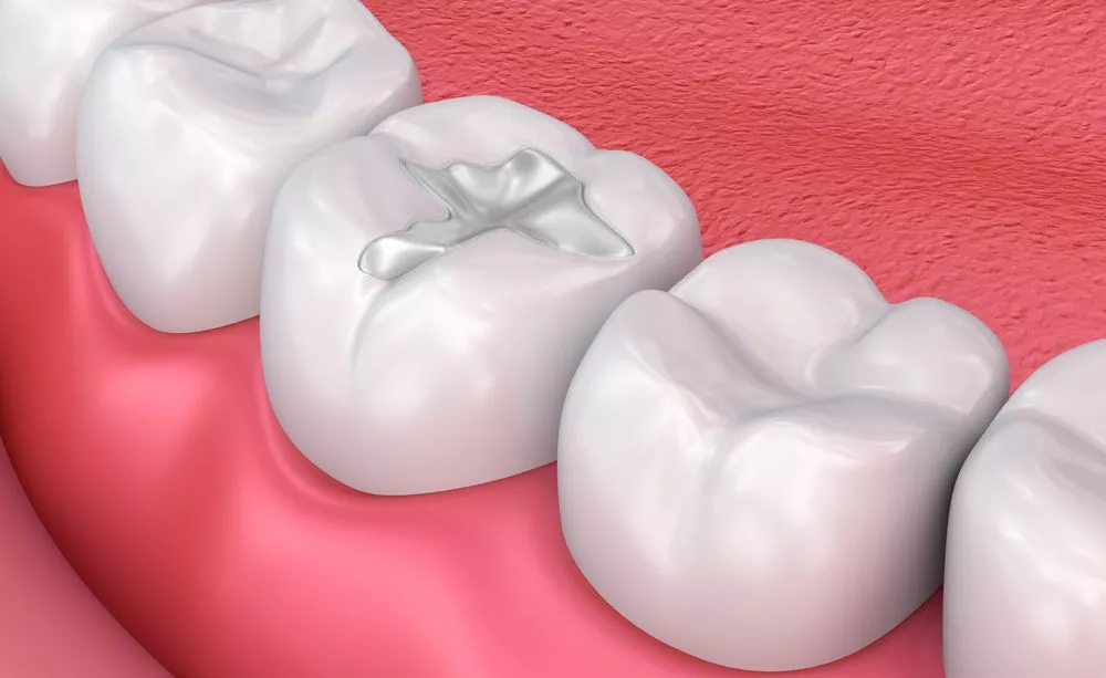 composite tooth-colored filling material chiangmai | วัสดุอุดฟันเรซินสีเหมือนฟัน เชียงใหม่ |