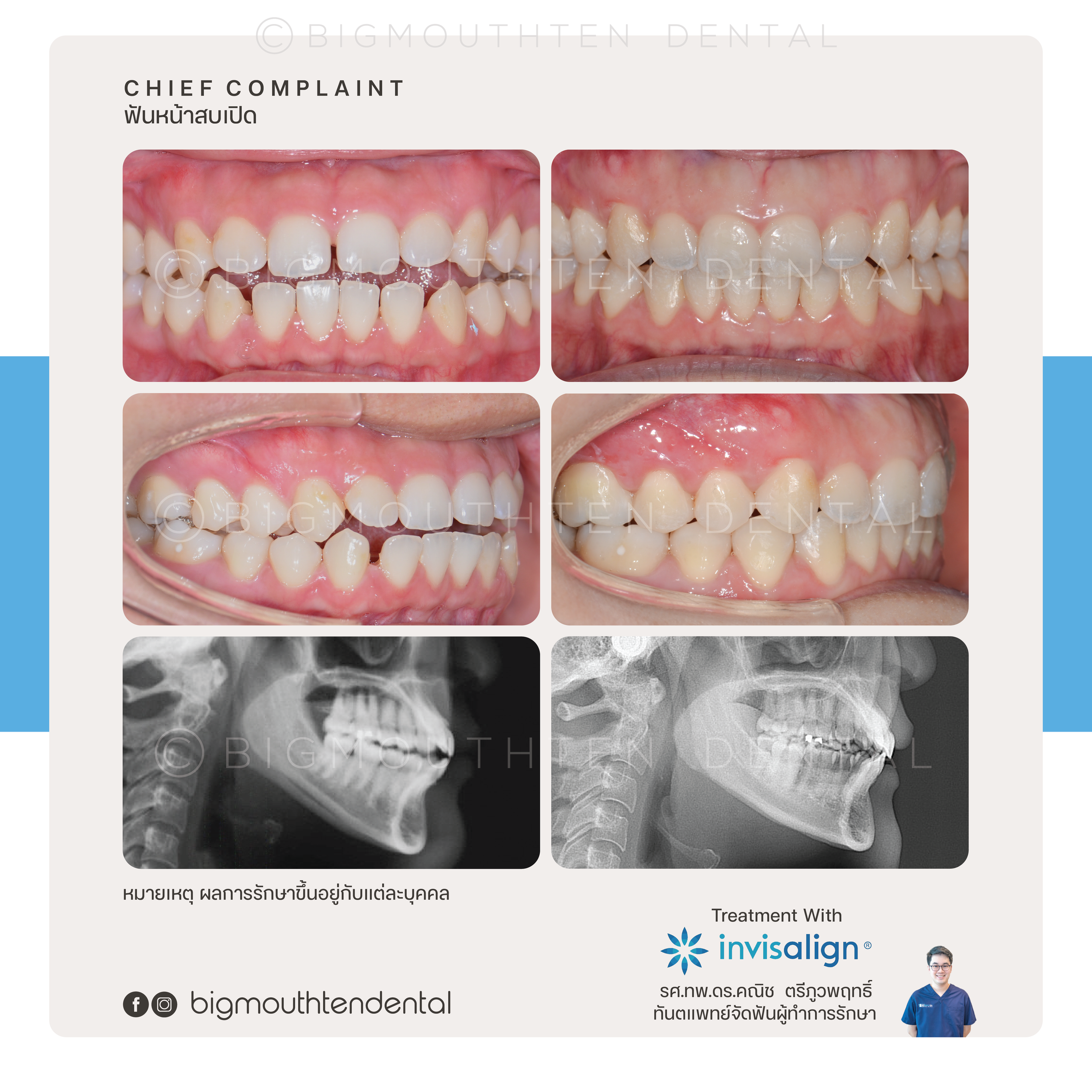ปรับรอยยิ้มด้วย Invisalign ก่อนและหลัง ที่คลินิกจัดฟันเชียงใหม่
