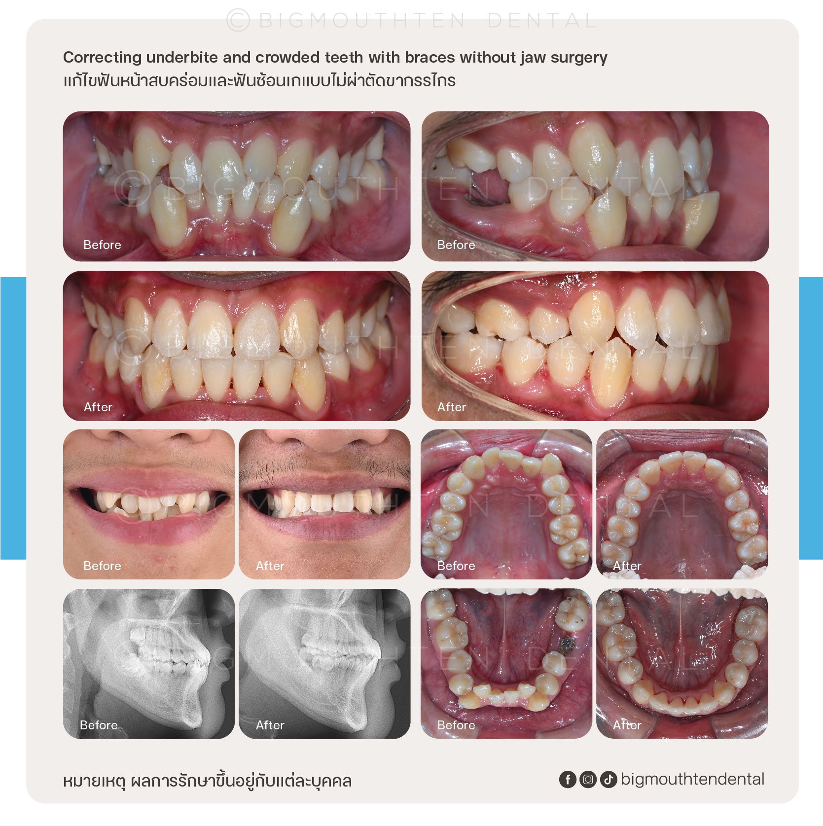 Before and after images showing dental correction of underbite and crowded teeth with braces, including close-up photos of teeth, facial smiles, and X-ray images, with text in English and Thai describing the procedure.