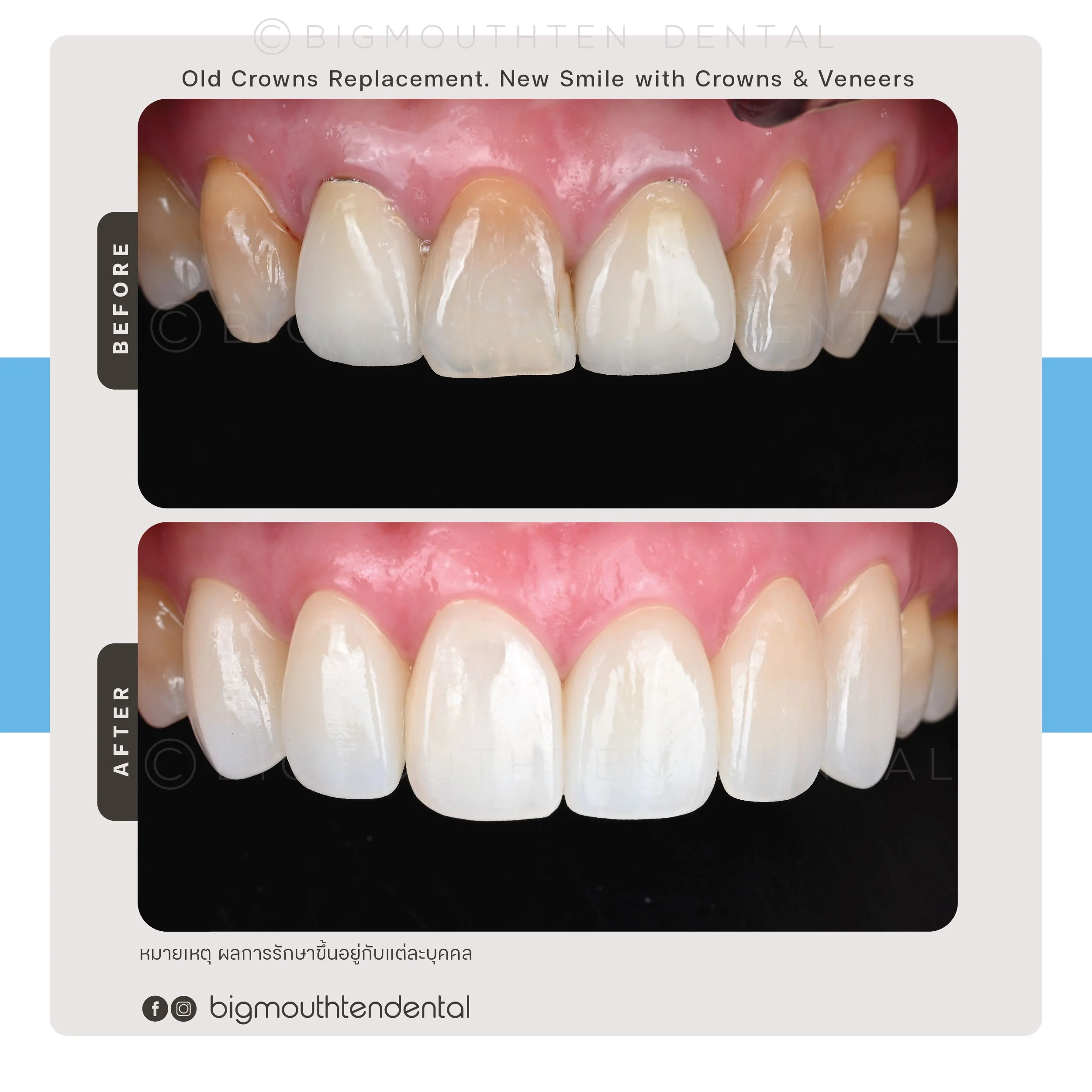 veneers-review-case-chiangmai.jpg.jpg