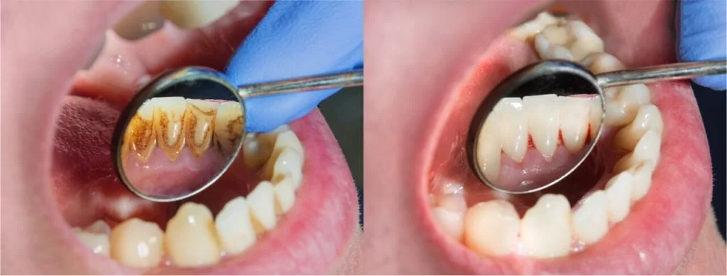 ก่อนและหลังขูดหินปูน เชียงใหม่ | before and after dental scaling chiangmai |