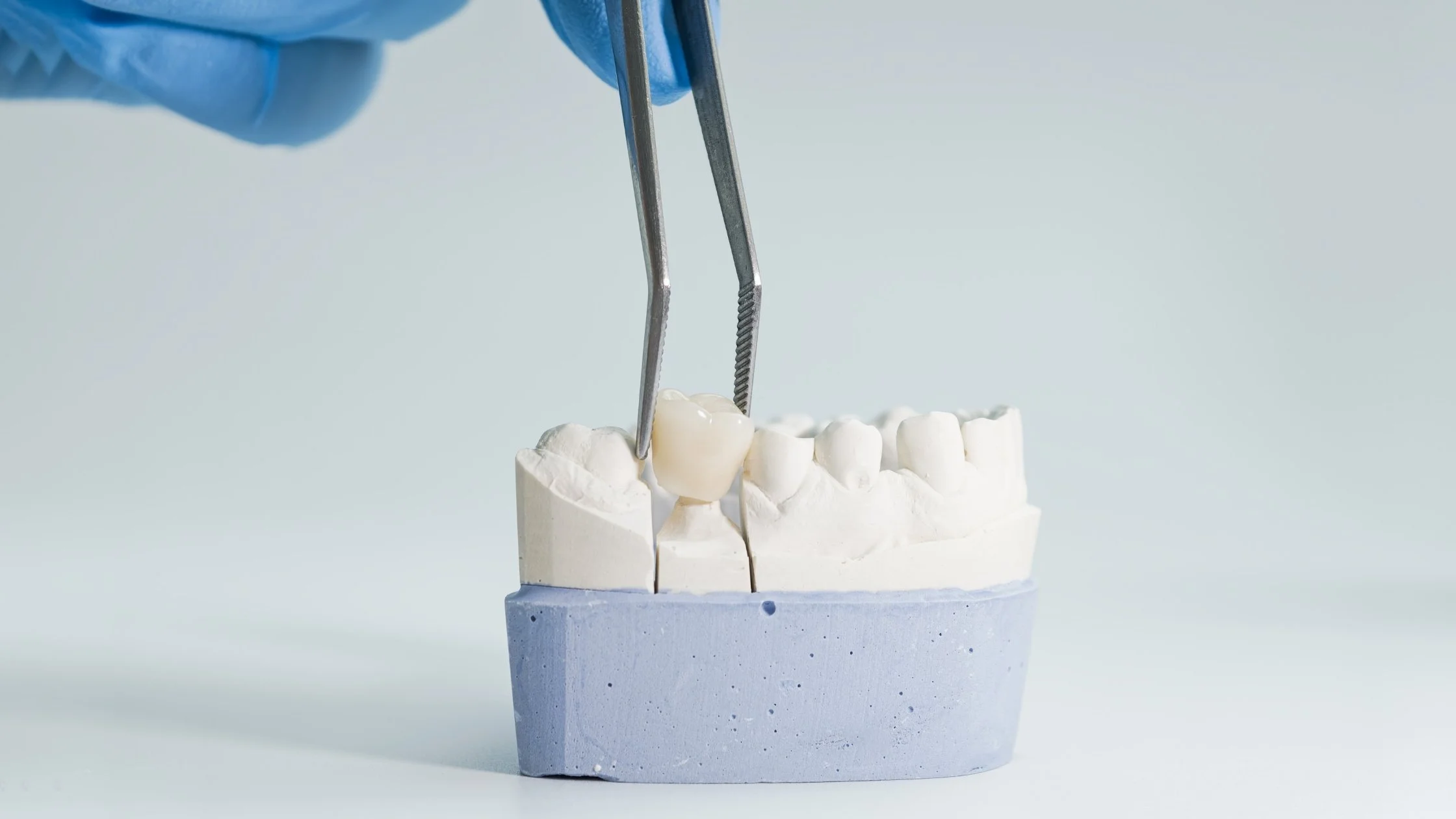 Dental Crown Frequently Asked Questions (2026)