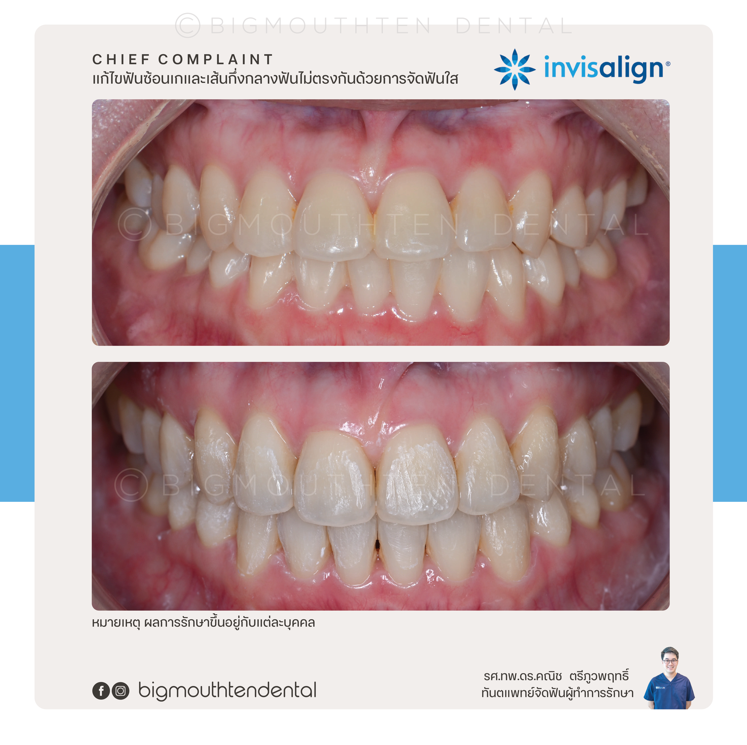 invisalign-aligners-bigmouthten-chiangmai.png