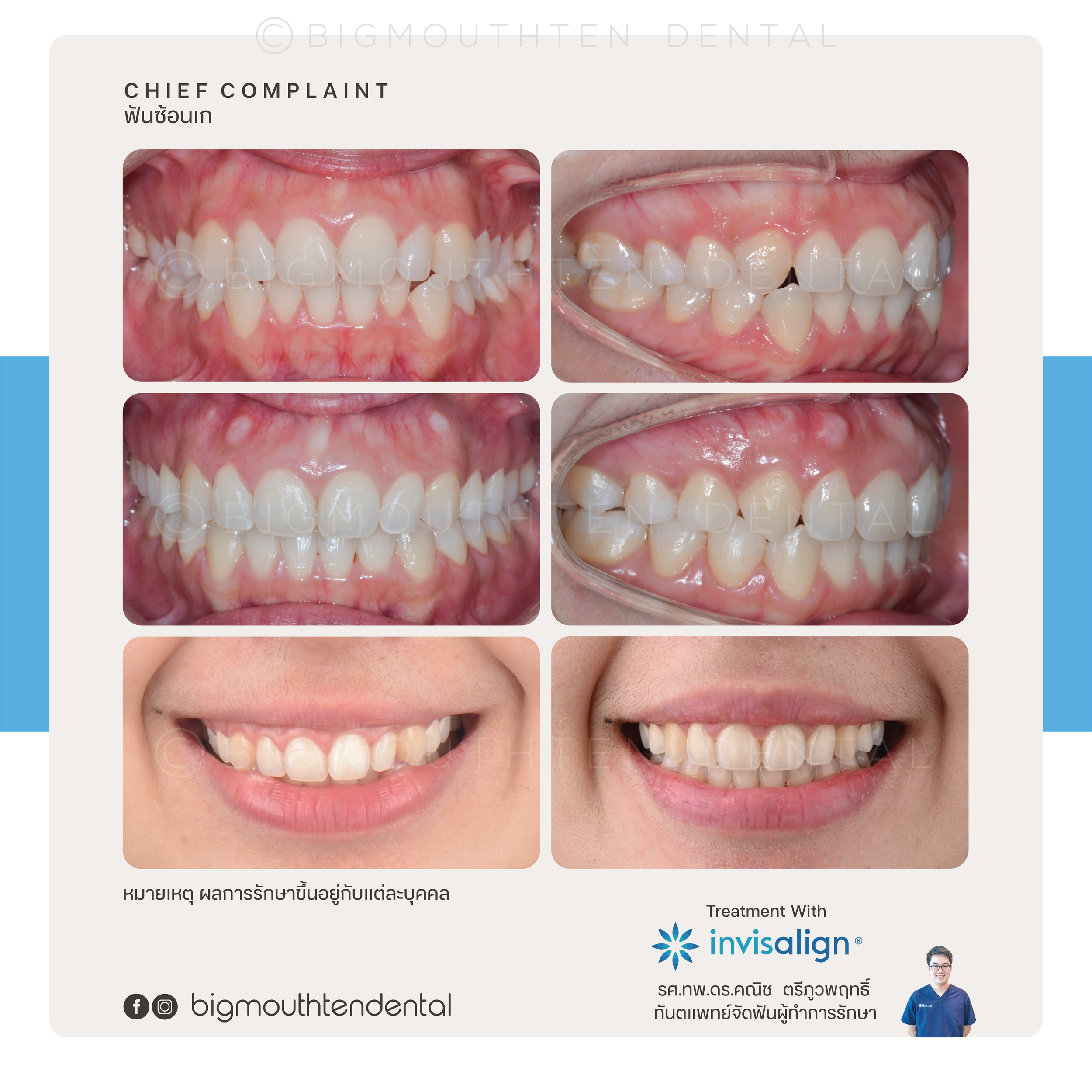 Before&After-ฺinvisalign-orthodontic-braces-bigmouthten-chiangmai.png