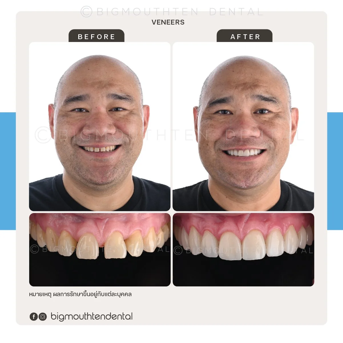 Before and after images of a man's teeth showing dental veneer treatment, with smiling face and close-up of teeth before and after procedure.