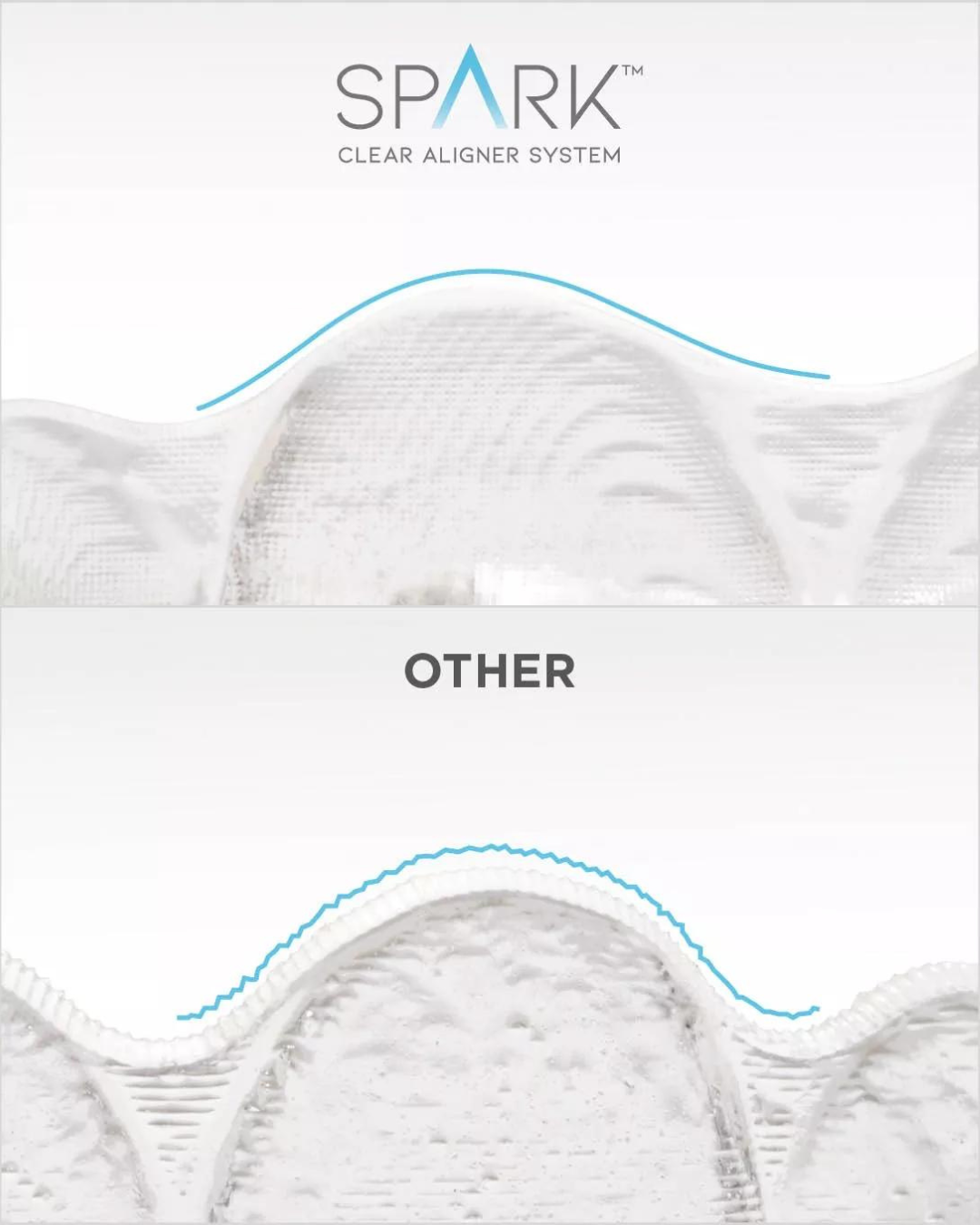 spark aligners chiangmai | จัดฟันใส Spark Aligners เชียงใหม่