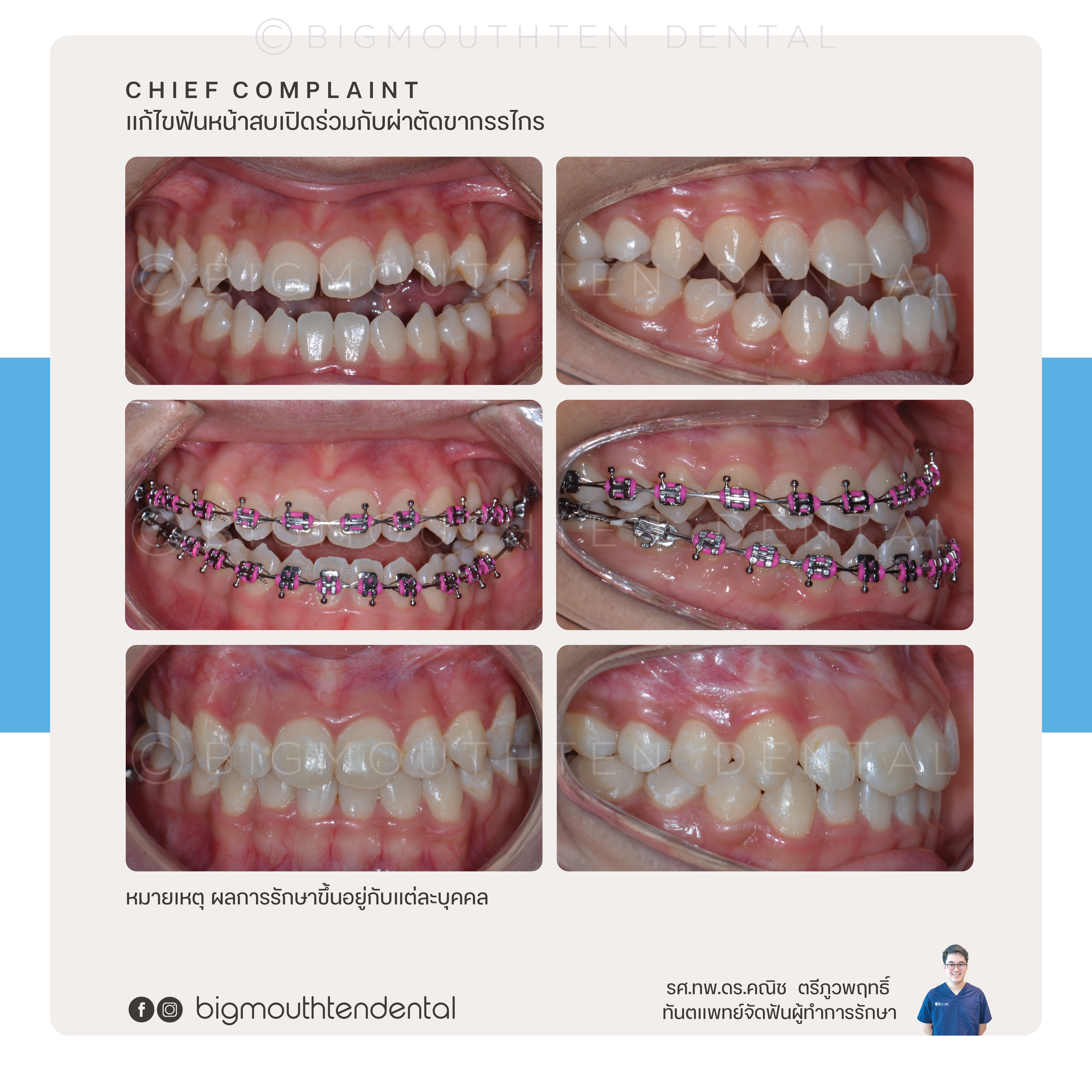 Set of six dental images showing teeth before and after orthodontic treatment with braces. The upper row shows the initial condition, the middle row shows teeth with braces, and the bottom row shows teeth after braces are removed, indicating improved