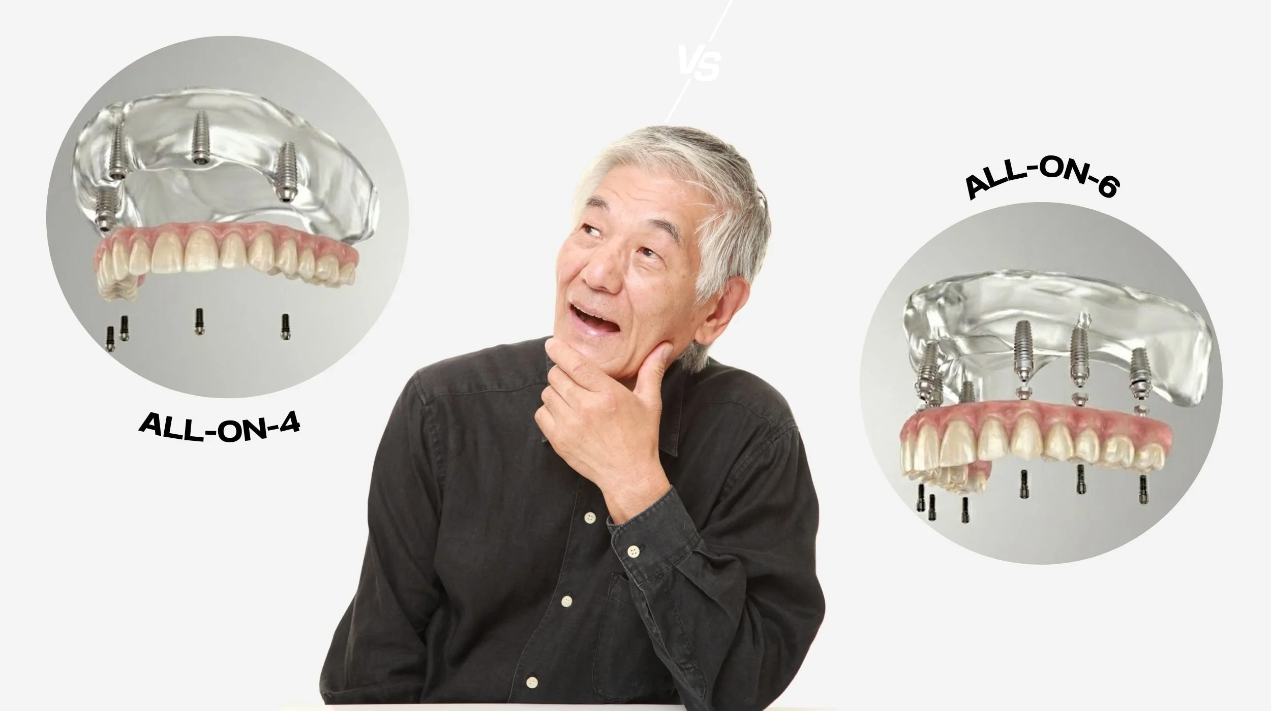 Comparison diagram between All-on-4 and All-on-6 dental implants showing the strategic placement and angles of 4 versus 6 titanium implants on the jawbone for full-arch reconstruction.