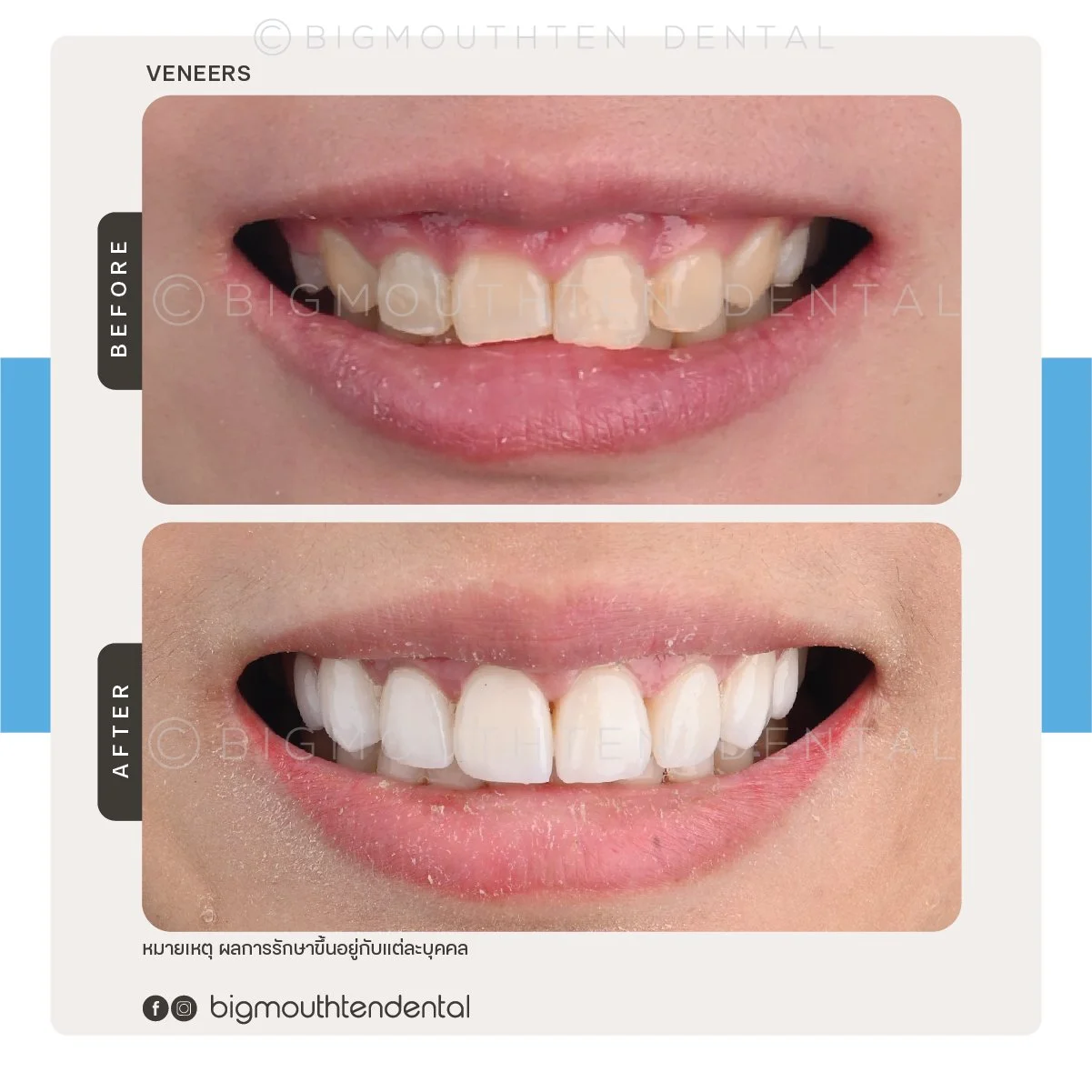 Comparison of teeth before and after dental treatment, showing improved appearance and alignment.