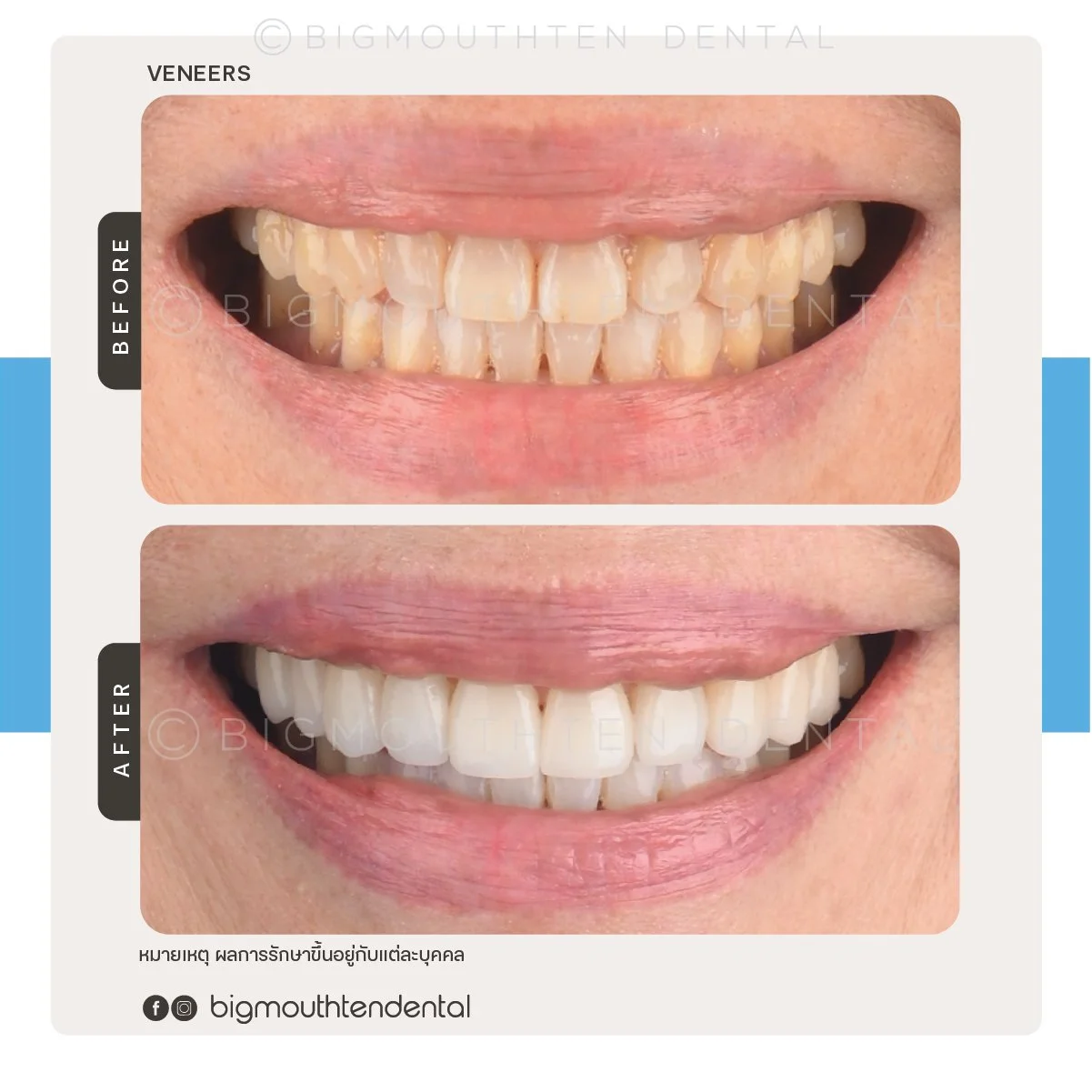 Comparison of a person's teeth before and after dental veneers treatment, showing significant whitening and improved alignment.