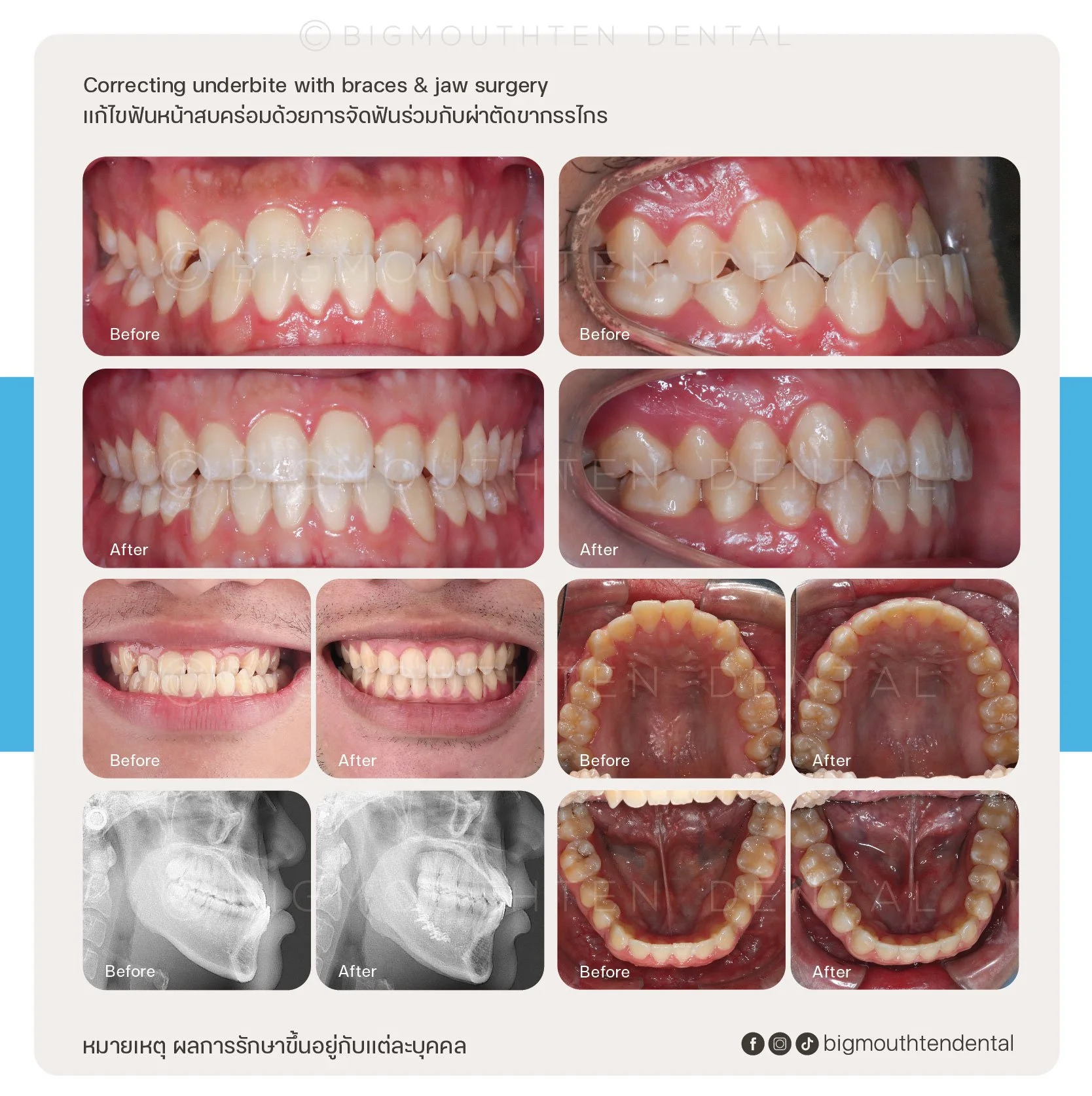 Comparison of dental corrections before and after braces and jaw surgery, showing improvements in teeth alignment, bite, and jaw structure.