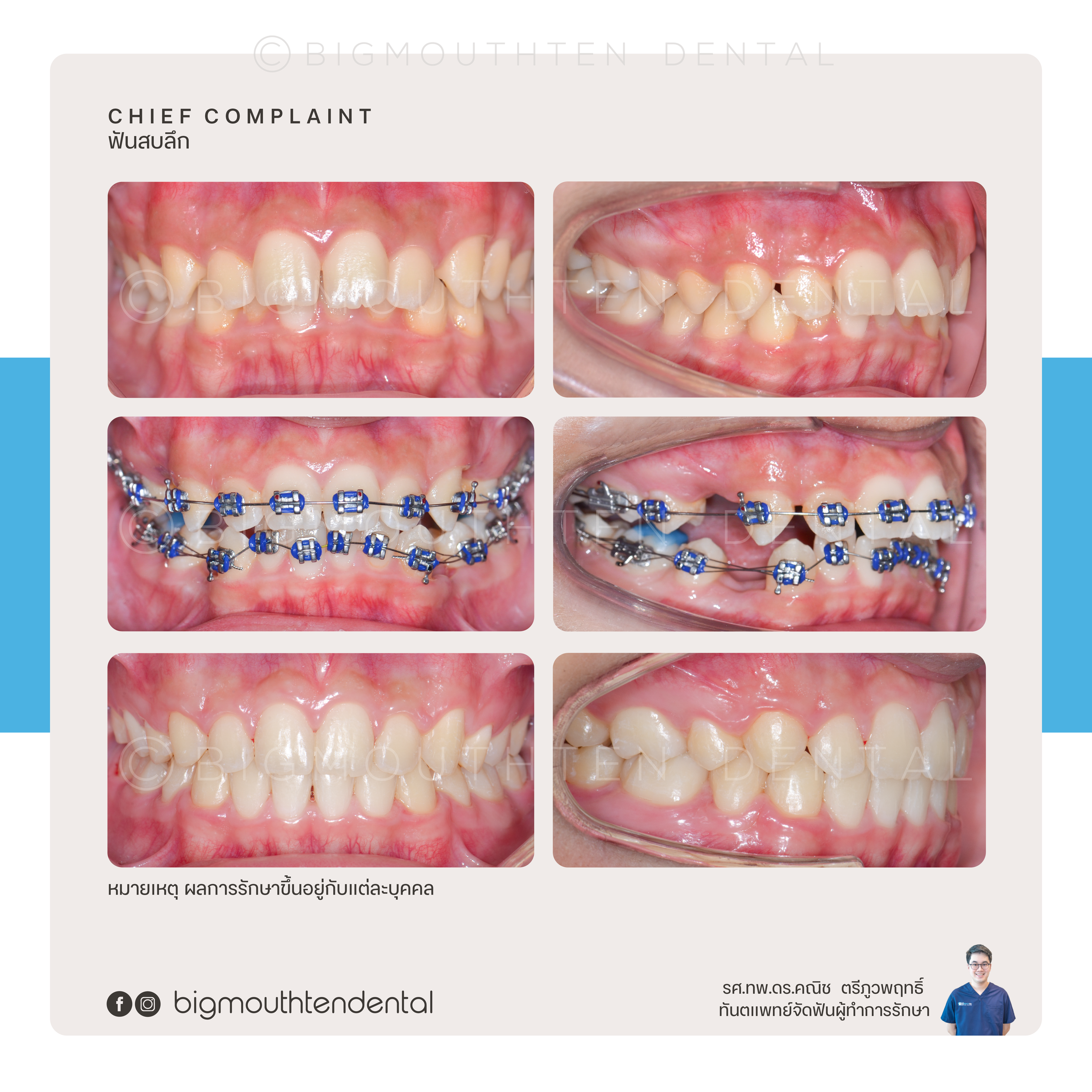 ก่อน–หลังจัดฟันแก้ฟันสบลึก โดยทันตแพทย์เฉพาะทาง ที่ Bigmouthten คลินิกเชียงใหม่ 