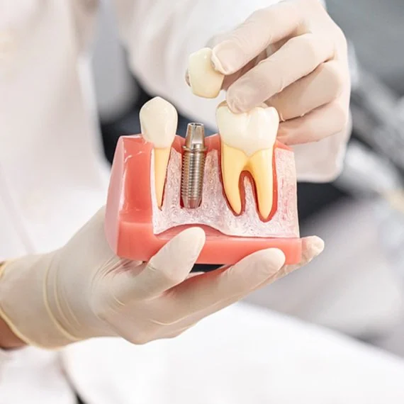 Dental implant model with a dentist's hand demonstrating tooth placement