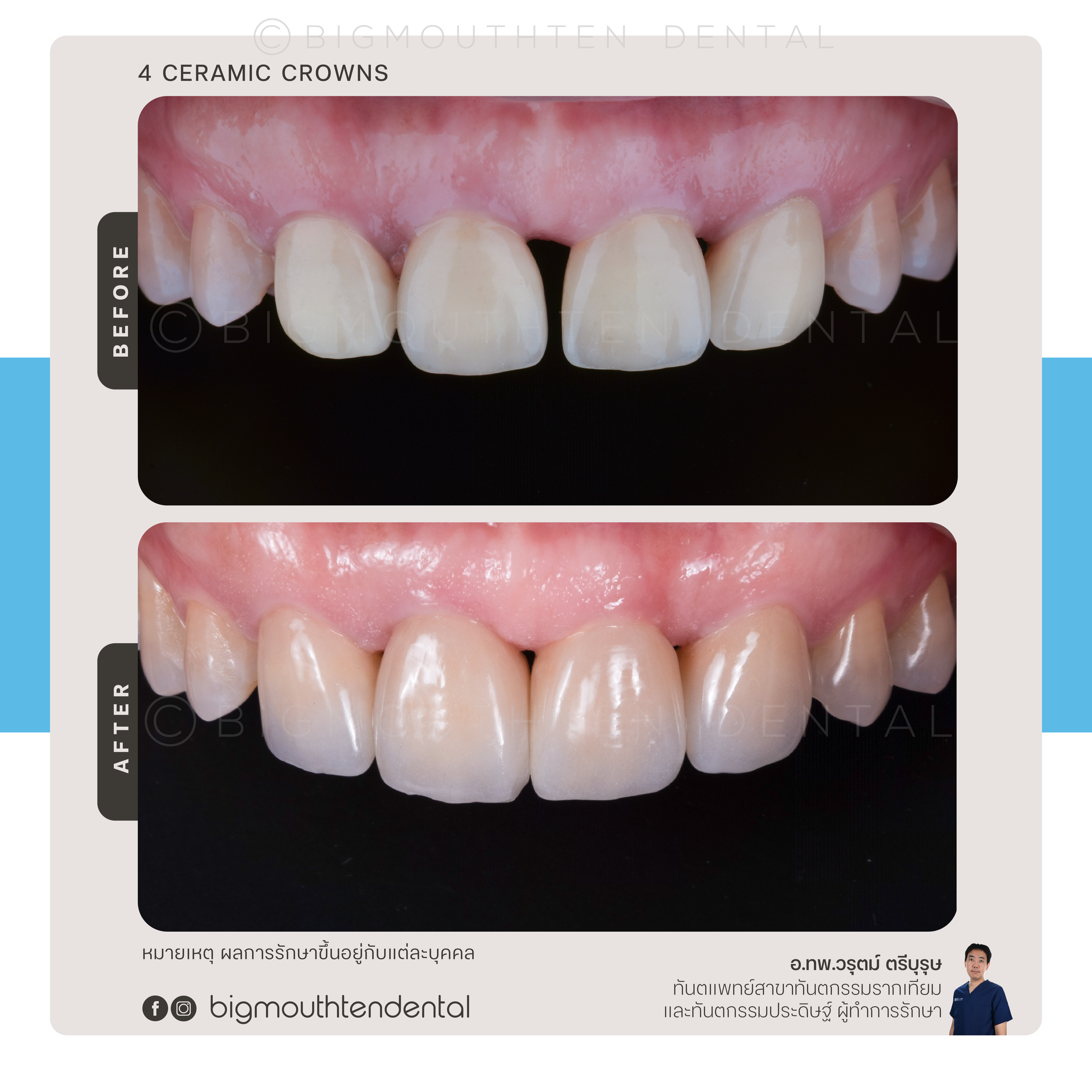 Before and after photos of dental work showing the replacement of ceramic crowns on front teeth, with the after image displaying more natural-looking teeth.