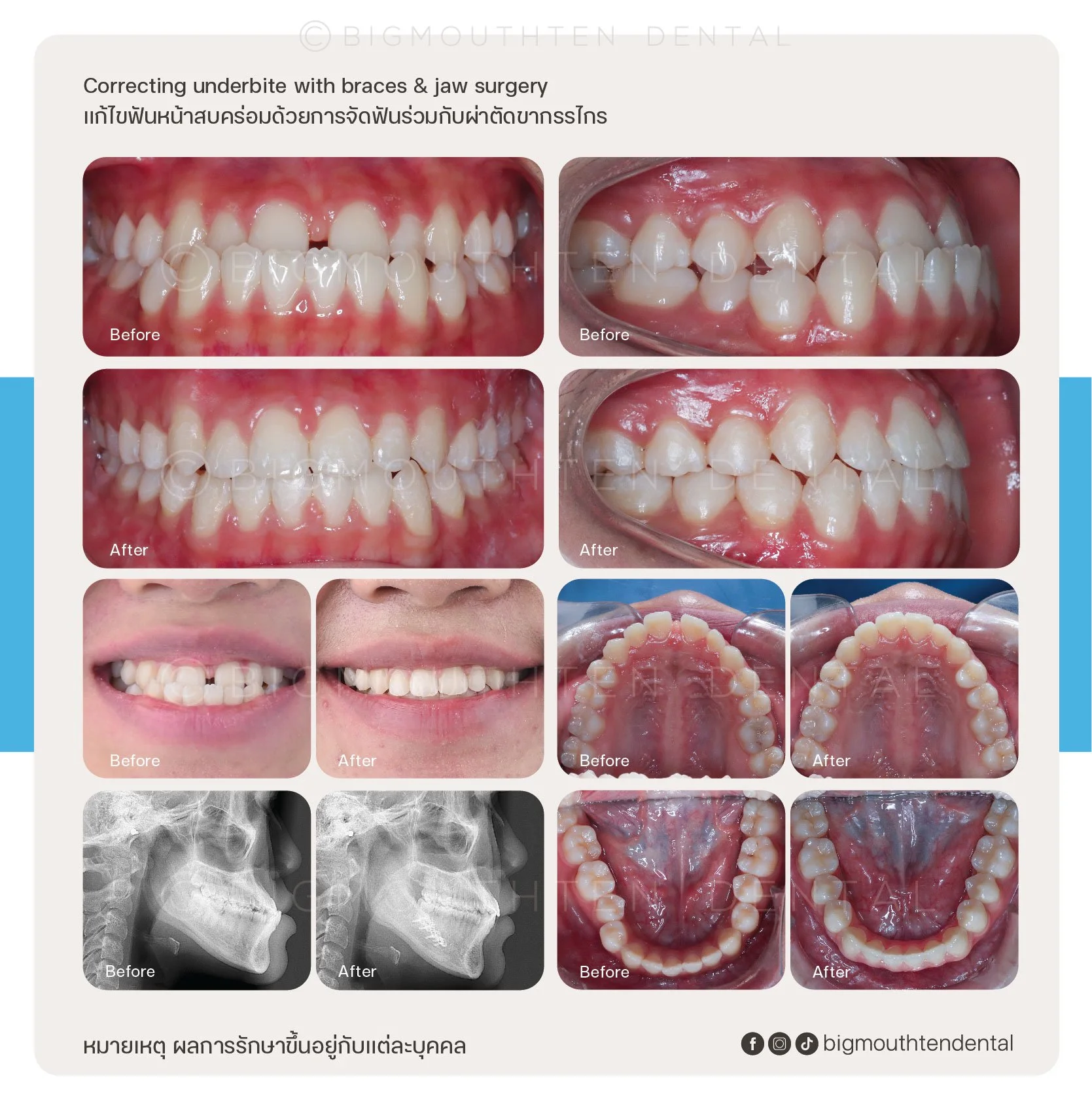 Images showing before and after dental correction and jaw surgery for underbite, including teeth, X-rays, and jaw views.