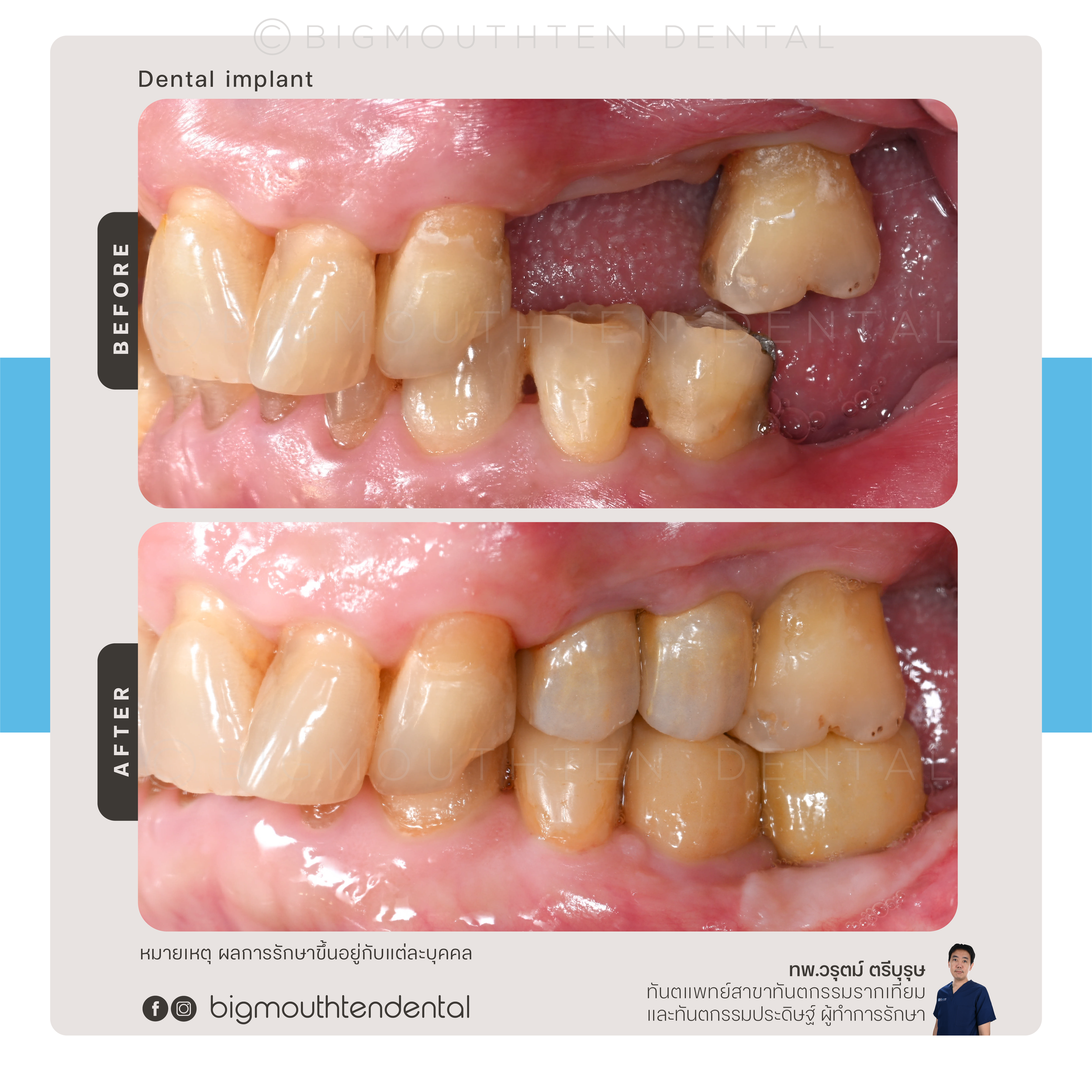 เปรียบเทียบก่อนและหลังปลูกรากเทียมในผู้สูงอายุ Before and after dental implant in elderly patient