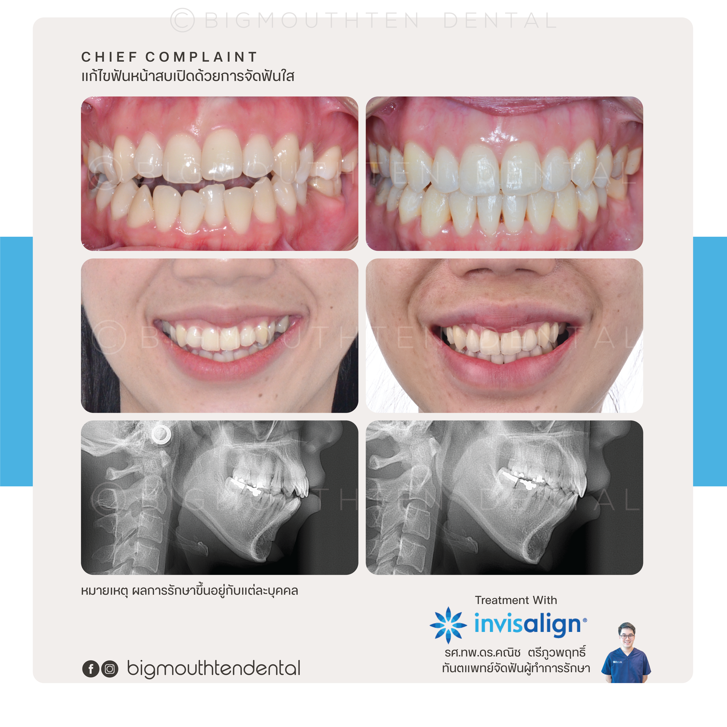 invisalign-aligners-bigmouthten-chiangmai.png