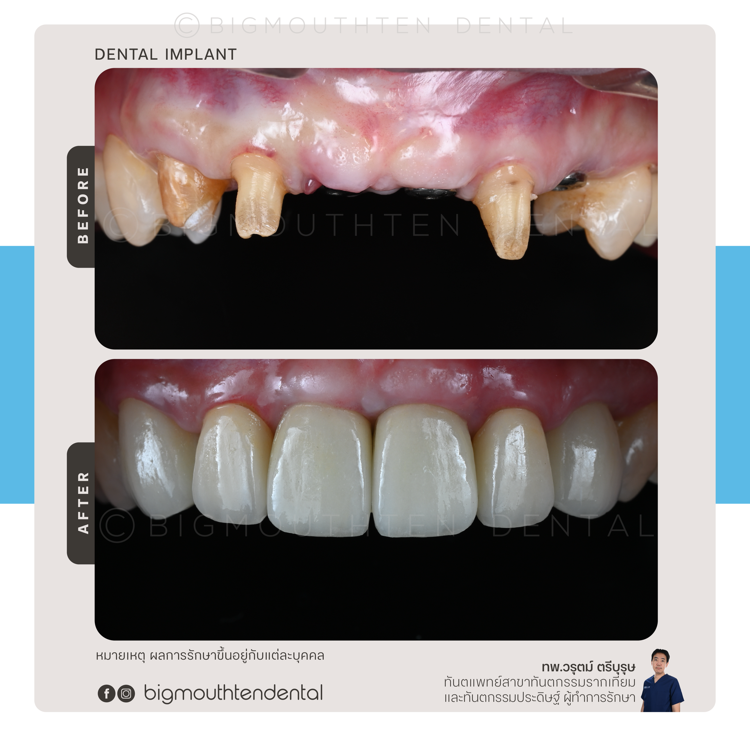 Comparison of teeth before and after dental implant restoration, showing damaged, decayed, or missing teeth in the top image and healthy, restored teeth in the bottom image.