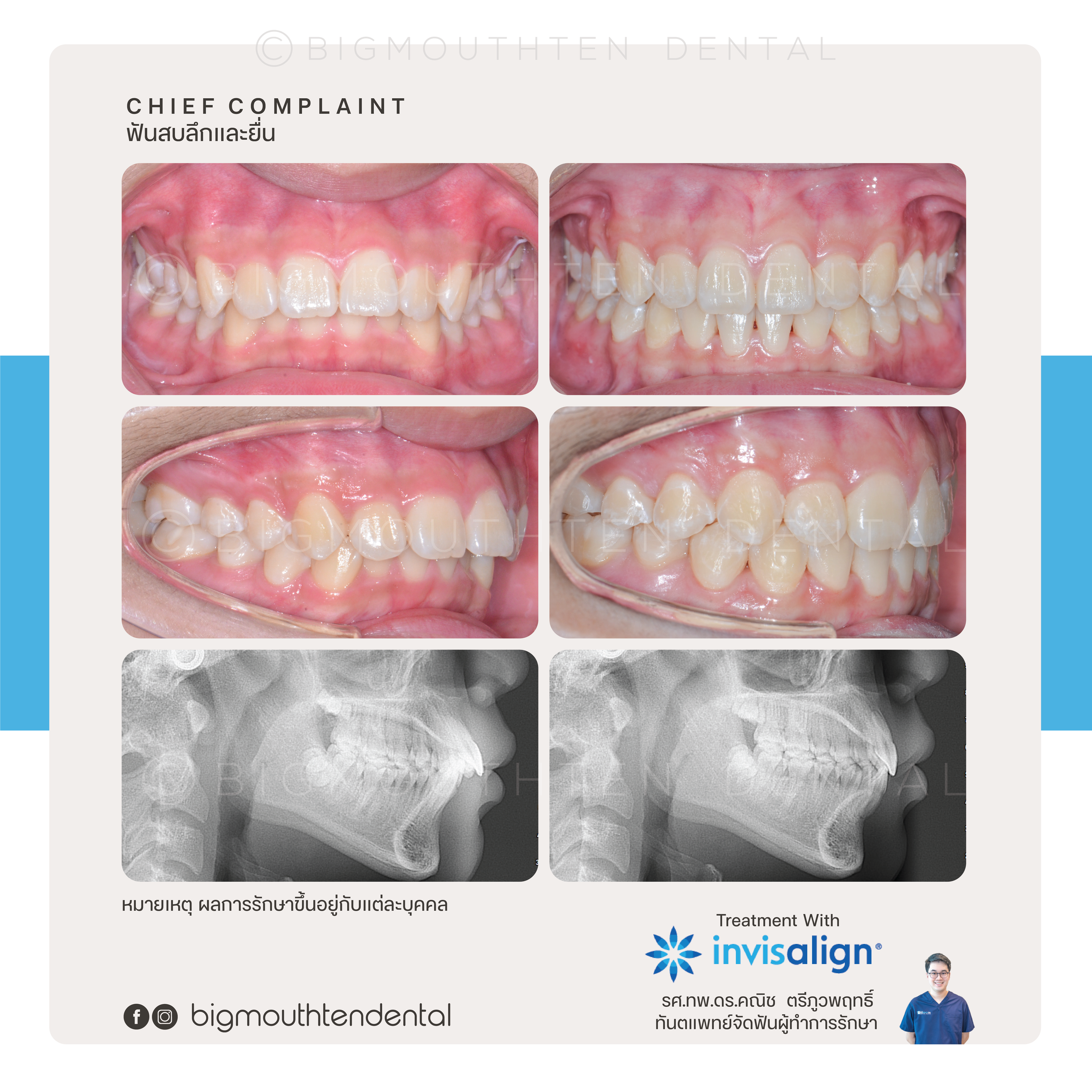 Before&After-ฺinvisalign-orthodontic-braces-bigmouthten-chiangmai.png
