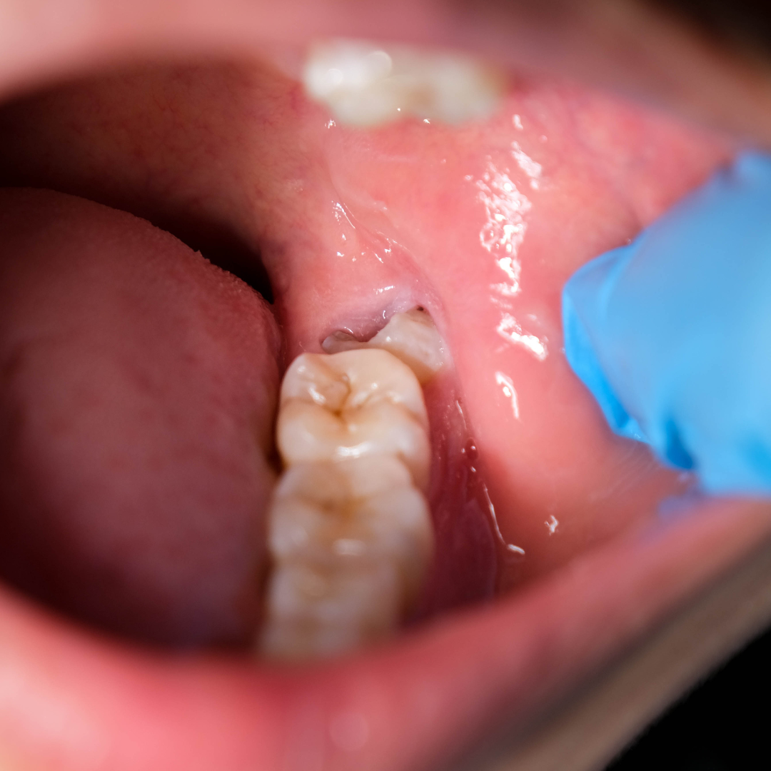 ฟันคุดอักเสบ เหงือกบวม ปวดกราม เชียงใหม่ | infected wisdom tooth and gum swelling chiangmai