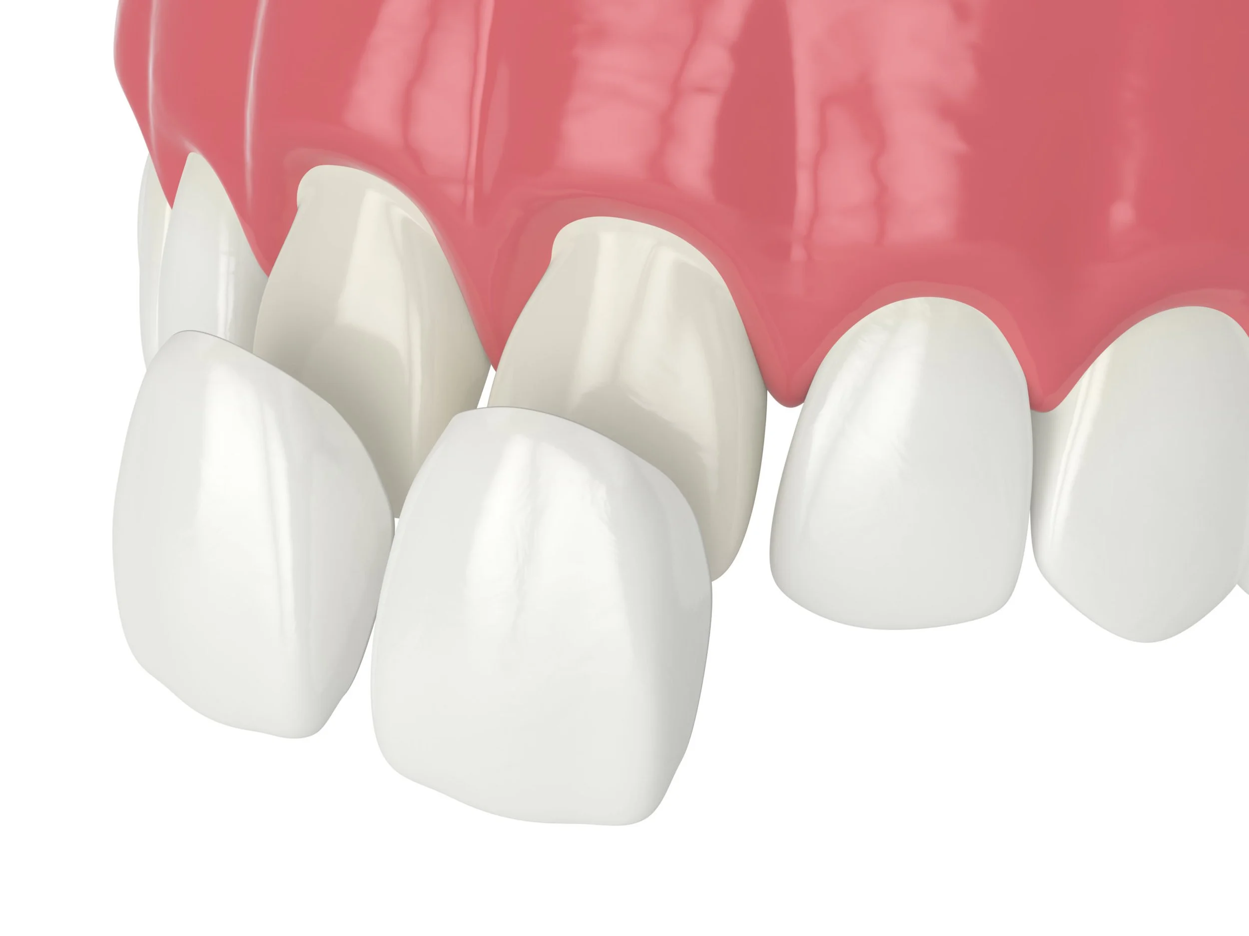Porcelain veneers for aesthetic smile improvement