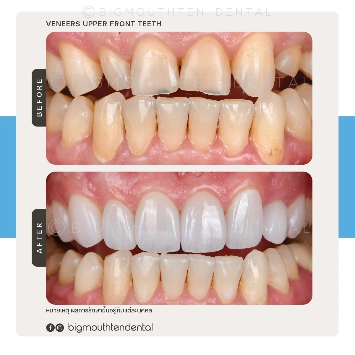 Comparison of teeth before and after dental treatment showing improved appearance and whitening.
