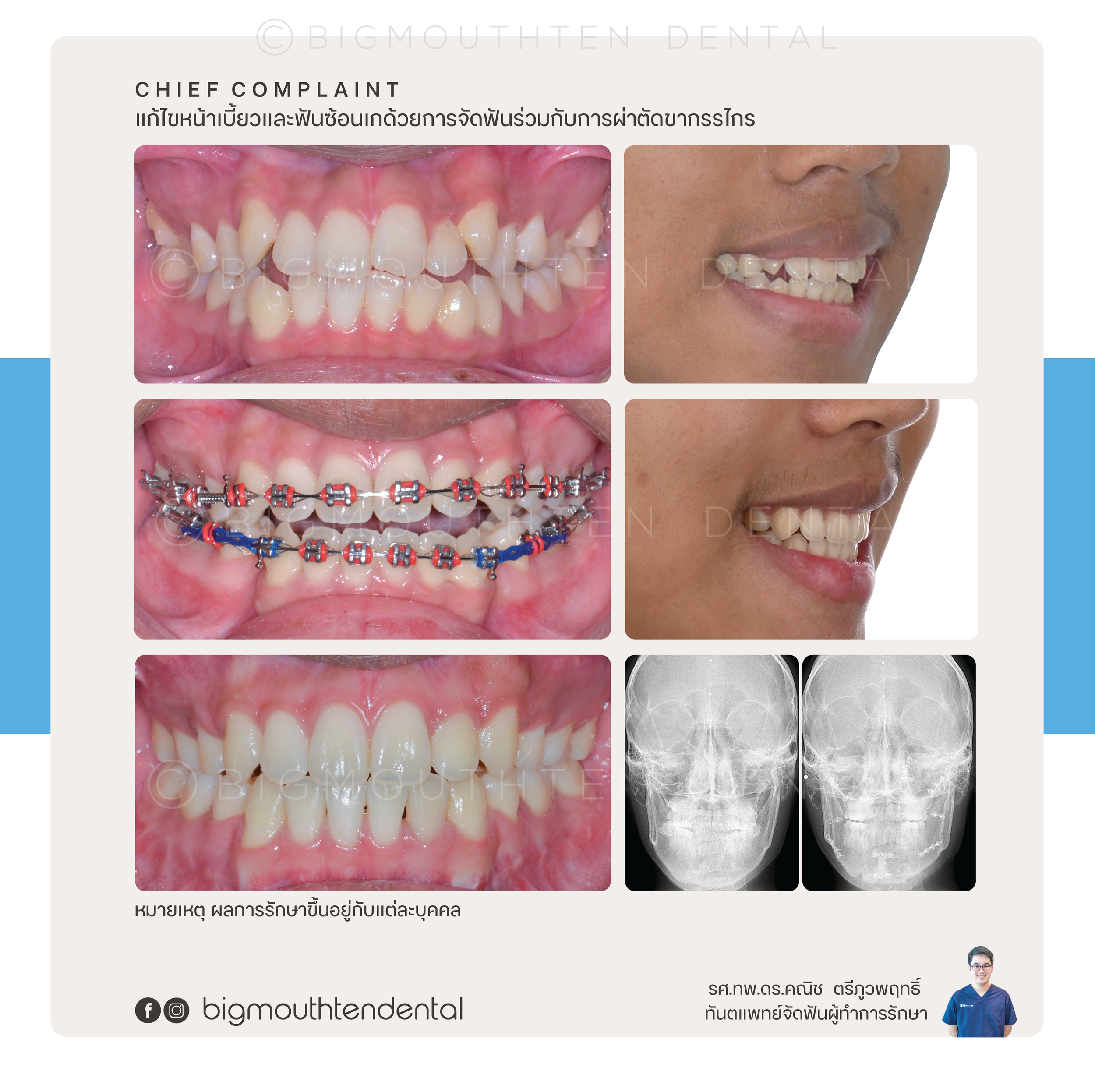 A dental treatment process showing initial teeth condition, placement of braces, and resulting teeth alignment, with before and after X-ray images.