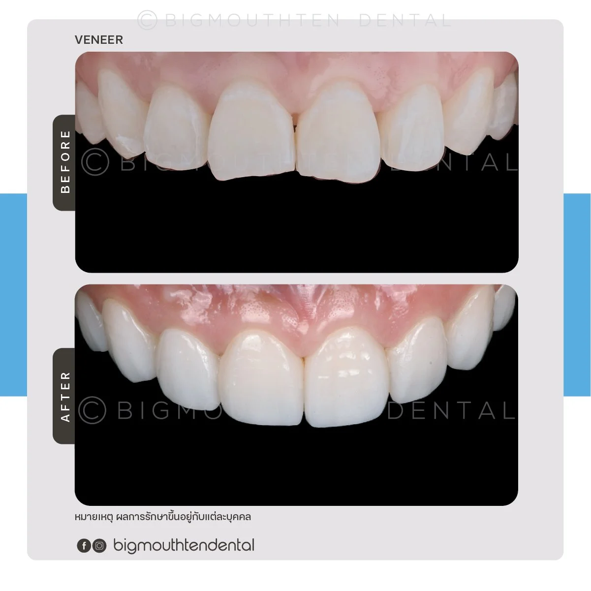 Comparison of teeth before and after dental veneer treatment. Top image shows teeth with chips and uneven edges, bottom image shows smooth, white, evenly shaped teeth after veneer placement.