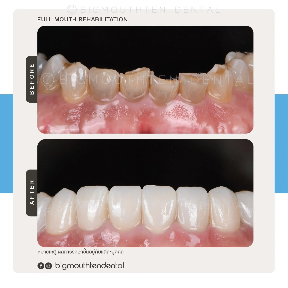 Comparison of teeth before and after dental treatment, showing improved whiteness and alignment after full mouth rehabilitation.