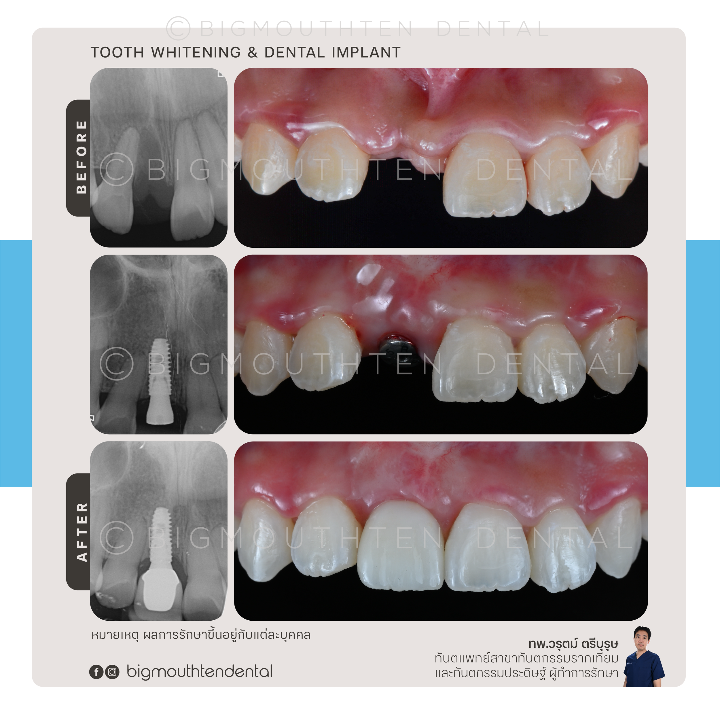 ก่อนและหลังฝังรากเทียม กับ ทพ.วรุตม์ ตรีบุรุษ Bigmouthten chiangmai