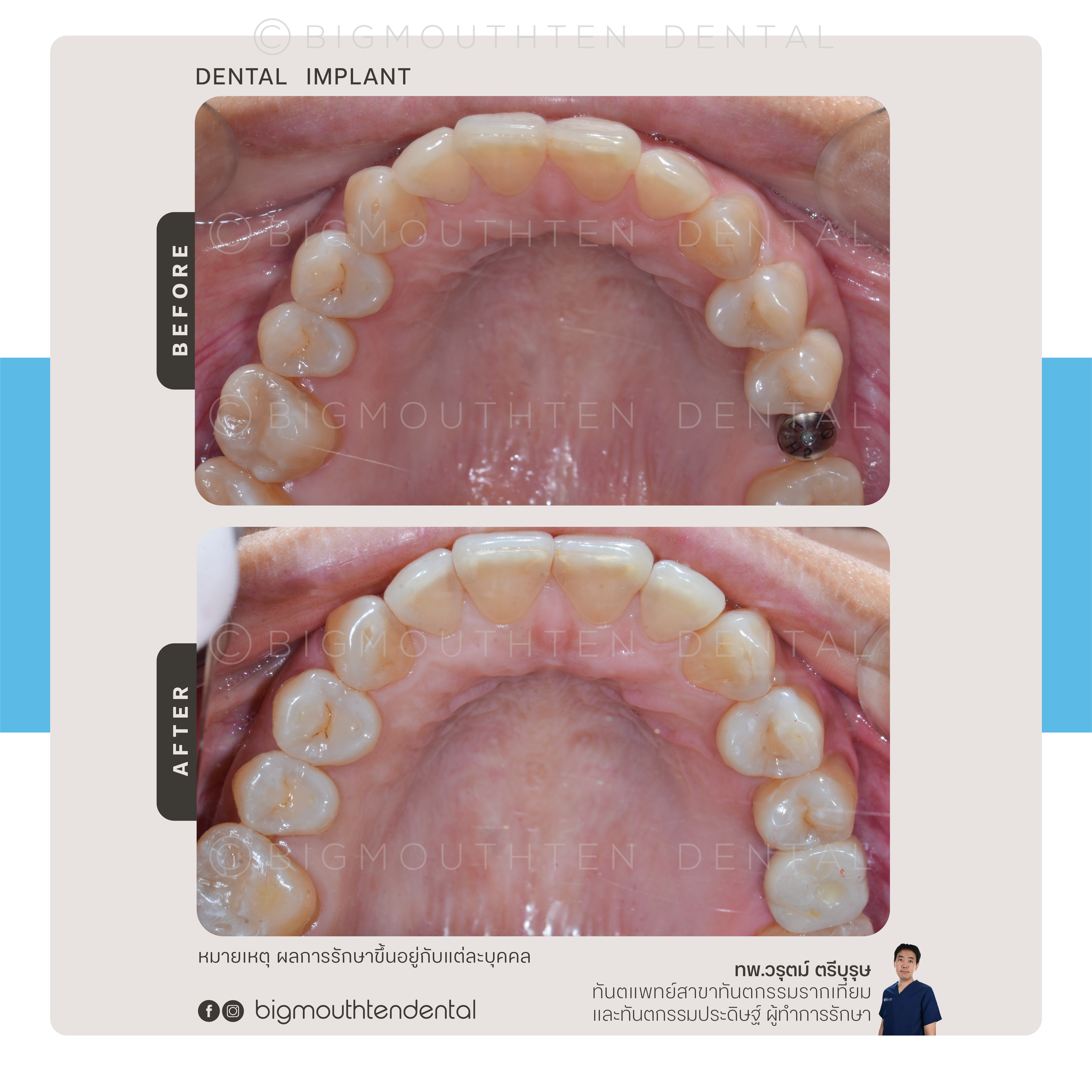 Before and after images of dental work showing a dental implant in the lower right molar area. The top image shows a dental implant post, and the bottom image shows the restored tooth after treatment.