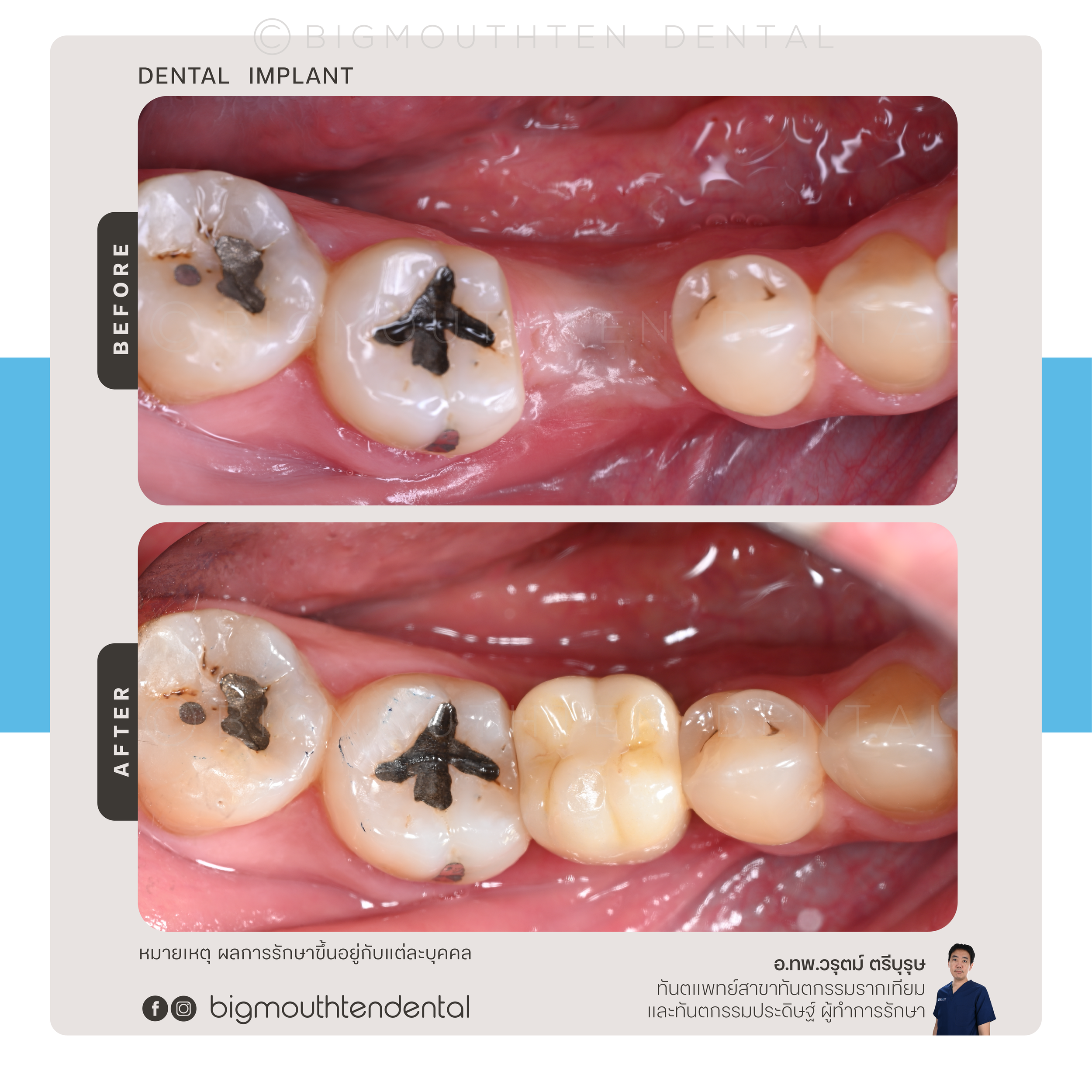 รีวิวผลลัพธ์รากฟันเทียม Megagen/Nobel Biocare
Implant result using Megagen or Nobel Biocare system