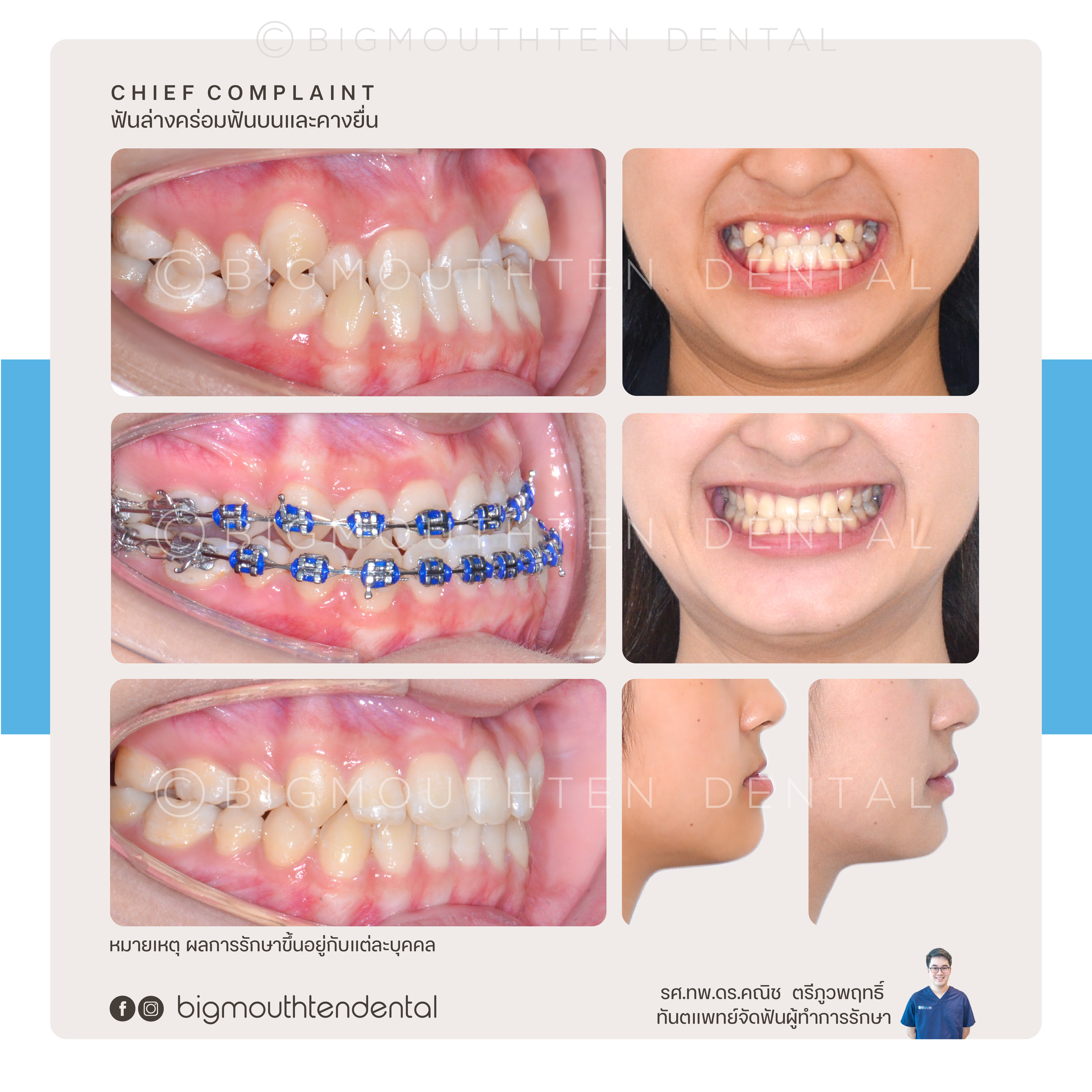 Dental treatment process showing before and after images of a patient's teeth, including orthodontic braces application, and side profile views of the patient's jaw alignment.