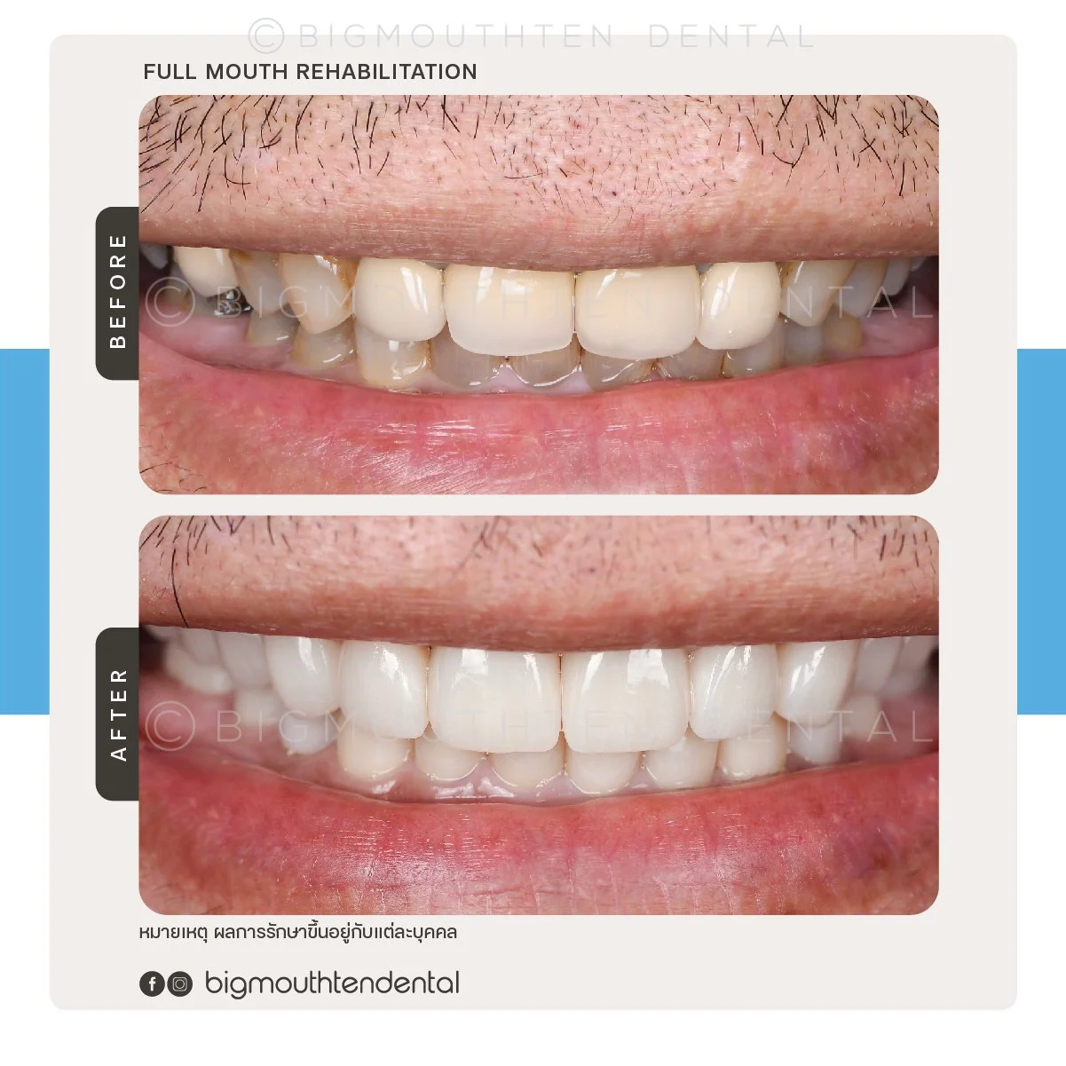 Before and after photos of full mouth dental rehabilitation showing improved teeth appearance.
