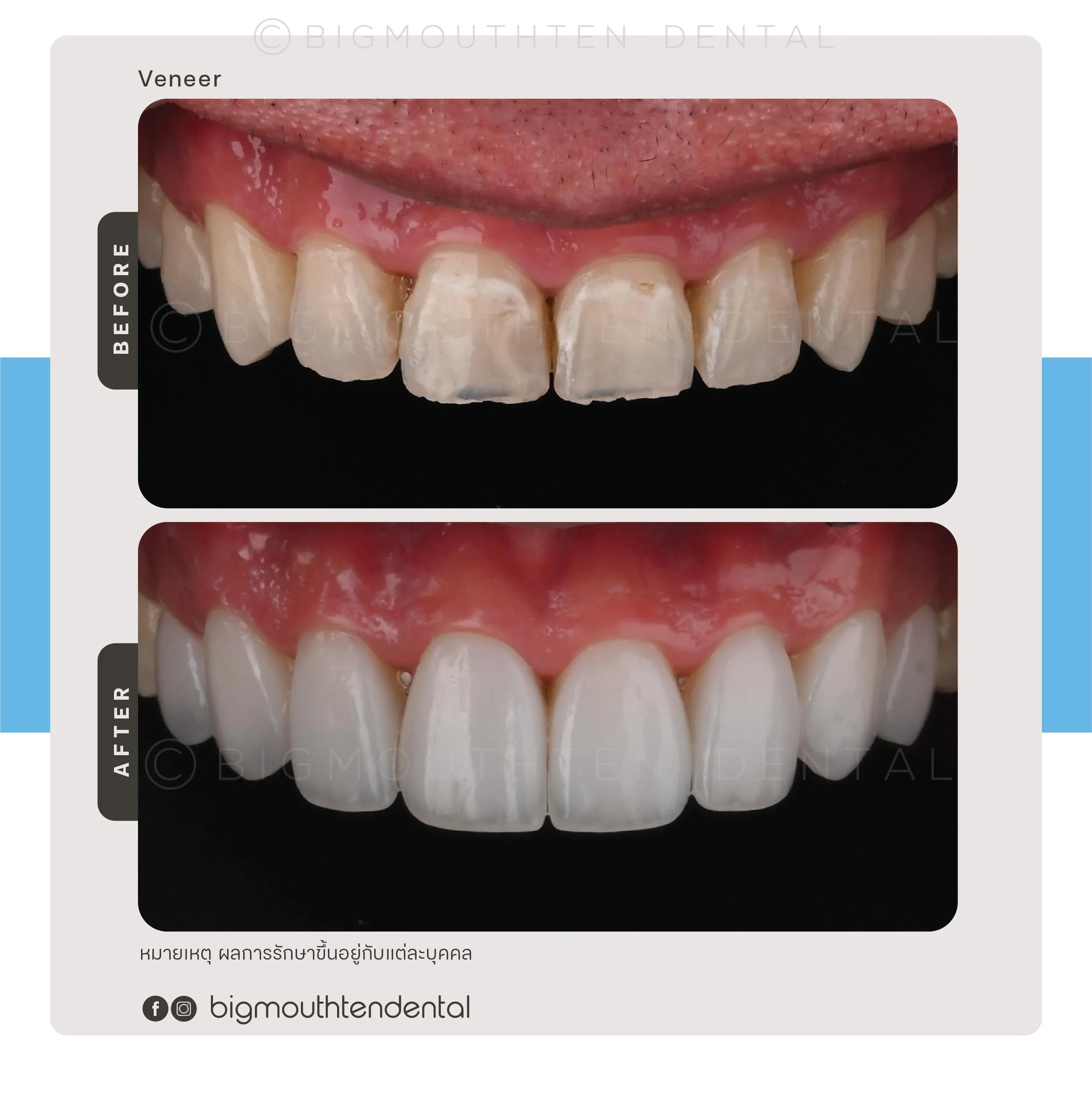 smile-makeover-veneers-chiangmai.jpg.jpg