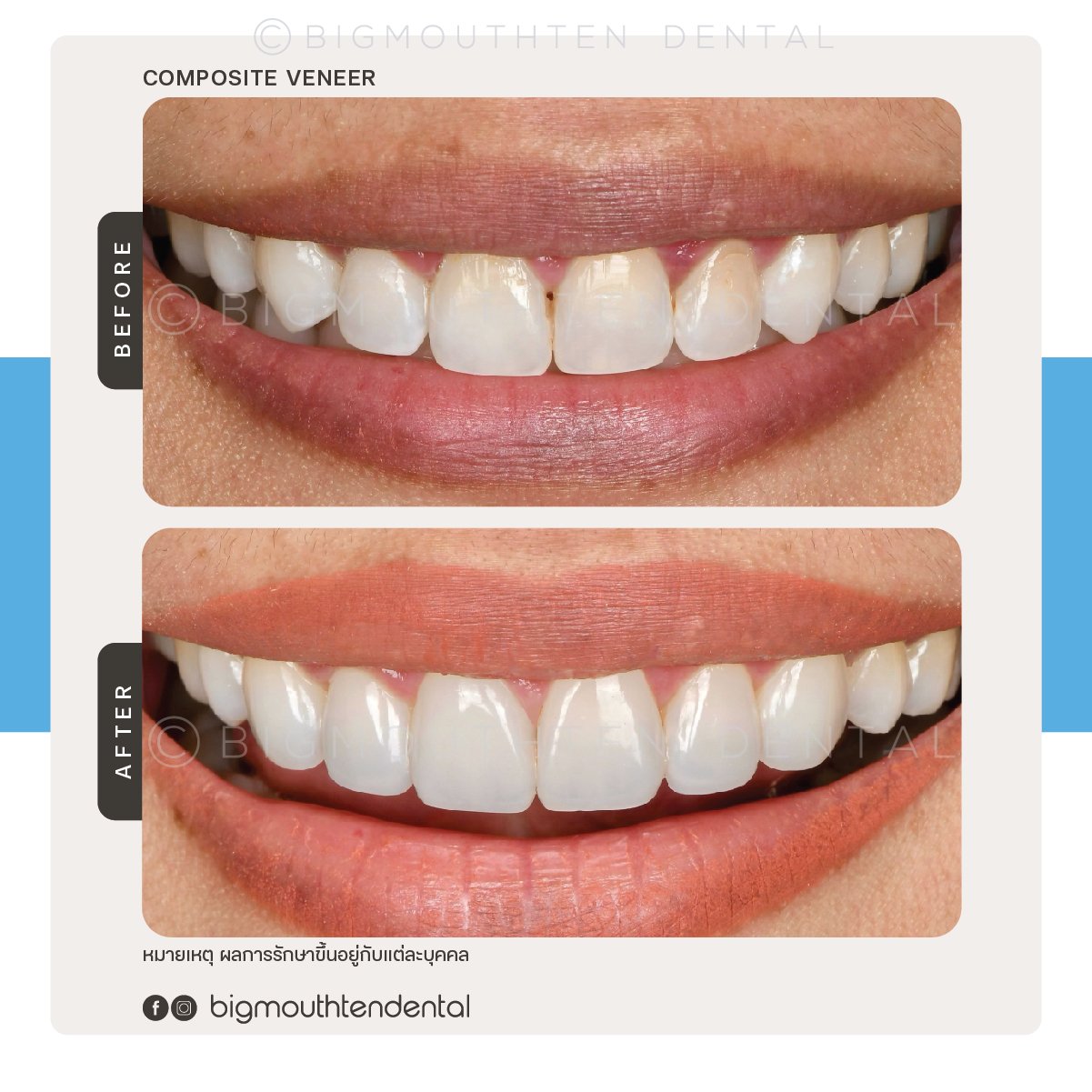 Comparison of a person's teeth before and after dental treatment showing improved alignment and whiteness.