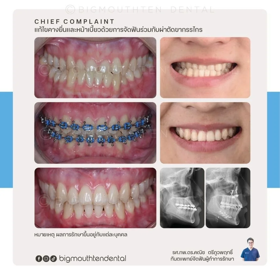 Before&After-jaw-surgery-orthodontic-braces-bigmouthten-chiangmai.jpg