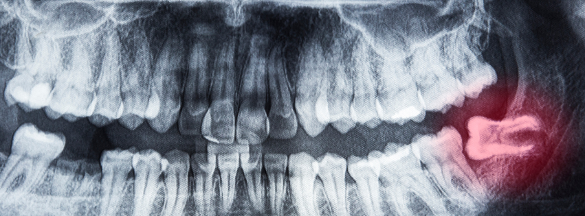 ภาพเอ็กซเรย์แสดงฟันคุดฝังในกระดูก เชียงใหม่ | impacted wisdom tooth in jaw x-ray chiangmai