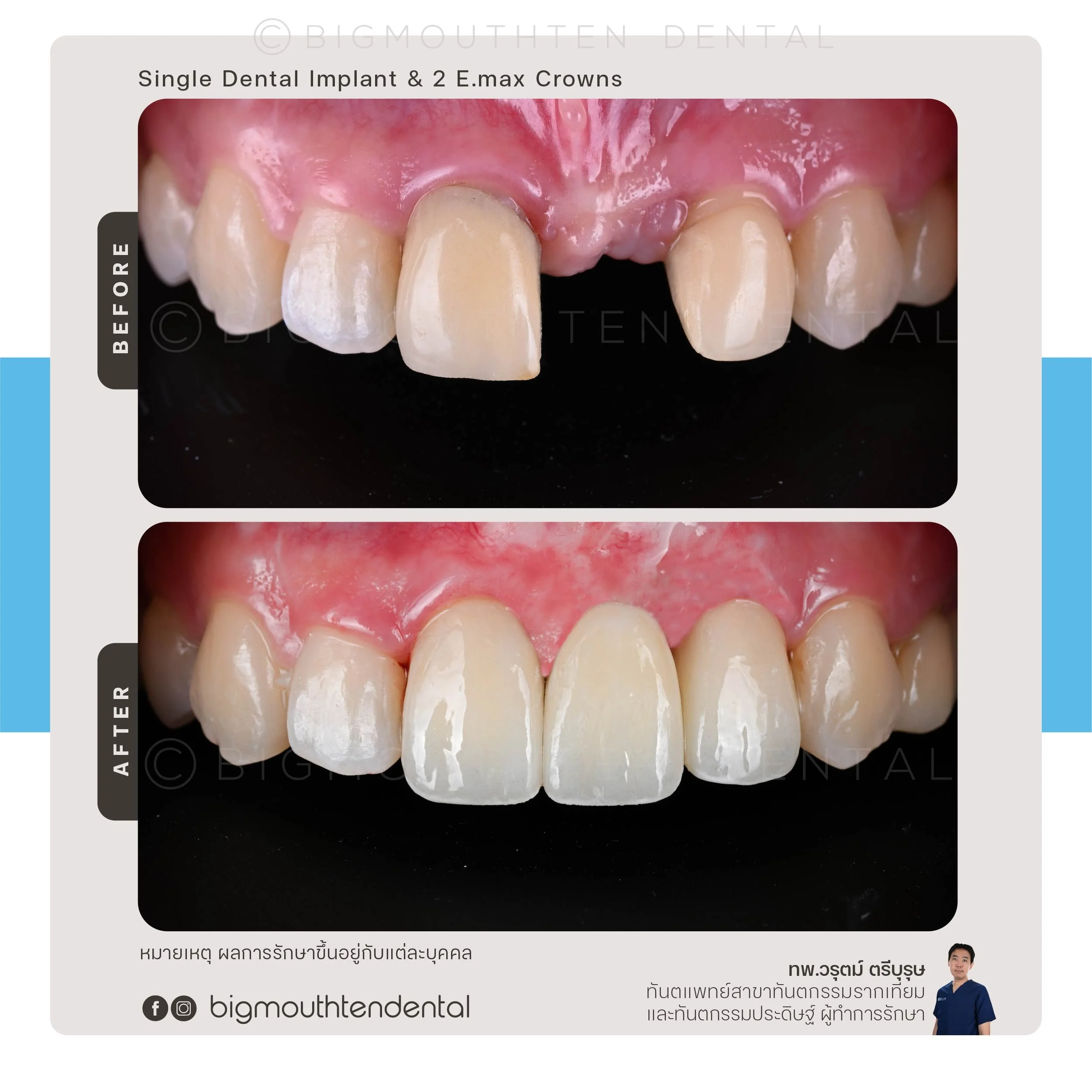 ผลลัพธ์ก่อนและหลังการรักษาด้วยรากฟันเทียม Megagen ที่คลินิกทันตกรรม Bigmouthten เชียงใหม่ Before and after dental implant treatment using Megagen at Bigmouthten Dental Clinic, Chiang Mai