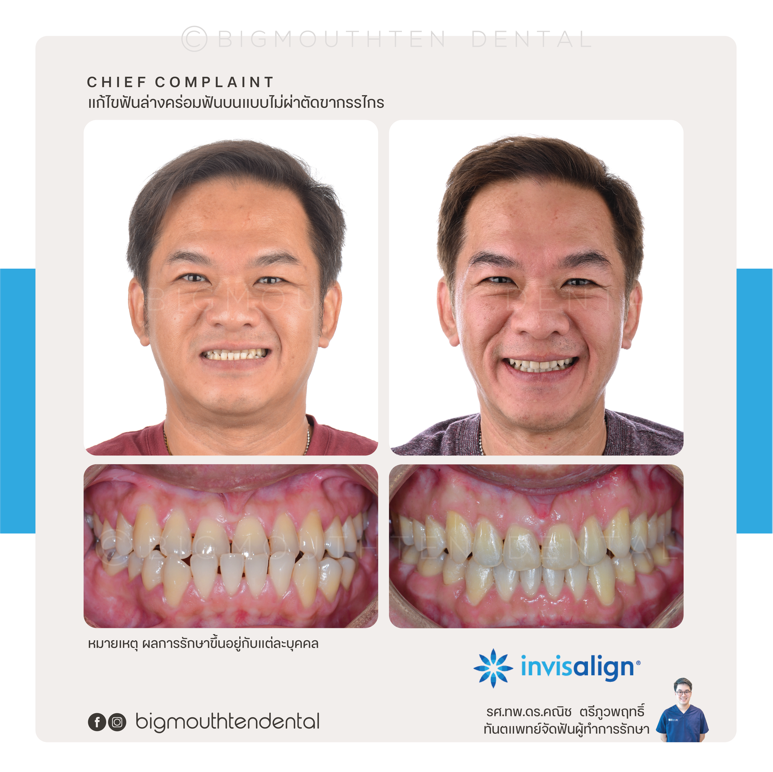 invisalign-aligners-bigmouthten-chiangmai.png
