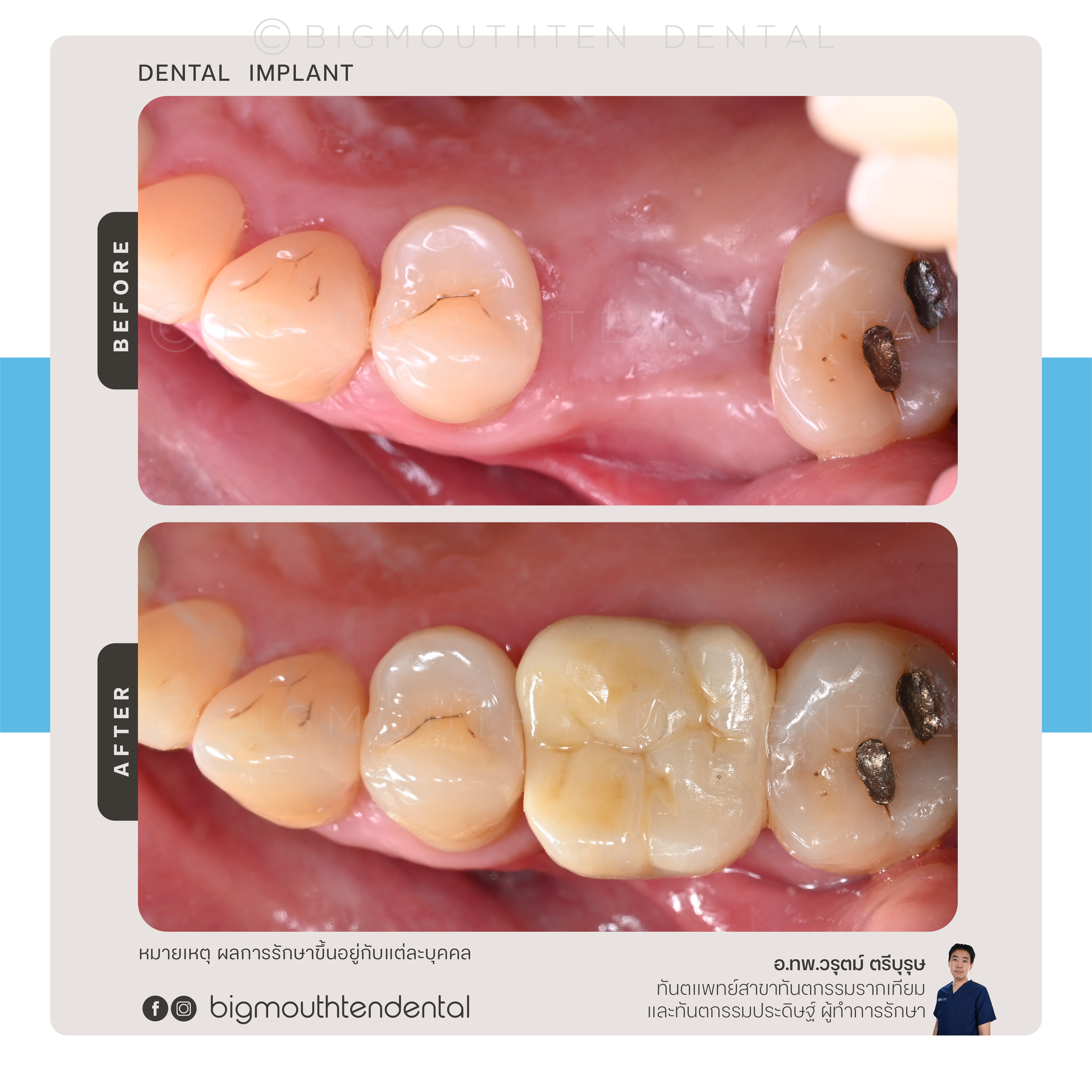 Close-up before and after images of dental restorations showing the replacement of a black amalgam filling with a composite filling on molar teeth, with the after image displaying restored natural tooth color.