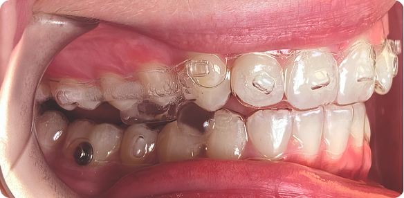 การใช้ BiteSync ใน Spark Aligners