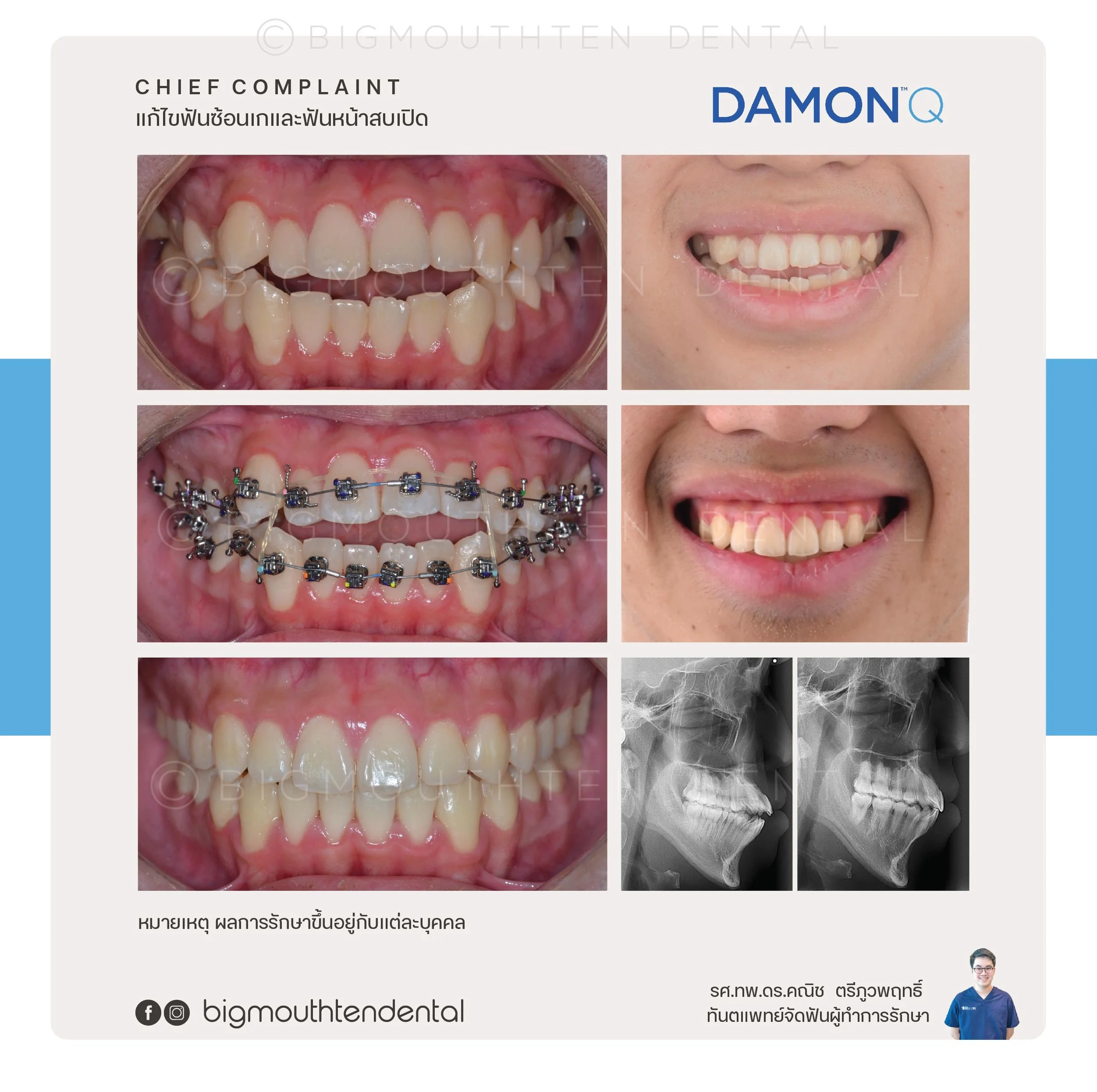 Sequence of dental images showing before and after treatment of braces. The top row displays initial crooked teeth, the middle row shows teeth with braces, and the bottom row reveals aligned teeth after braces removal. X-ray images of the jaw are als