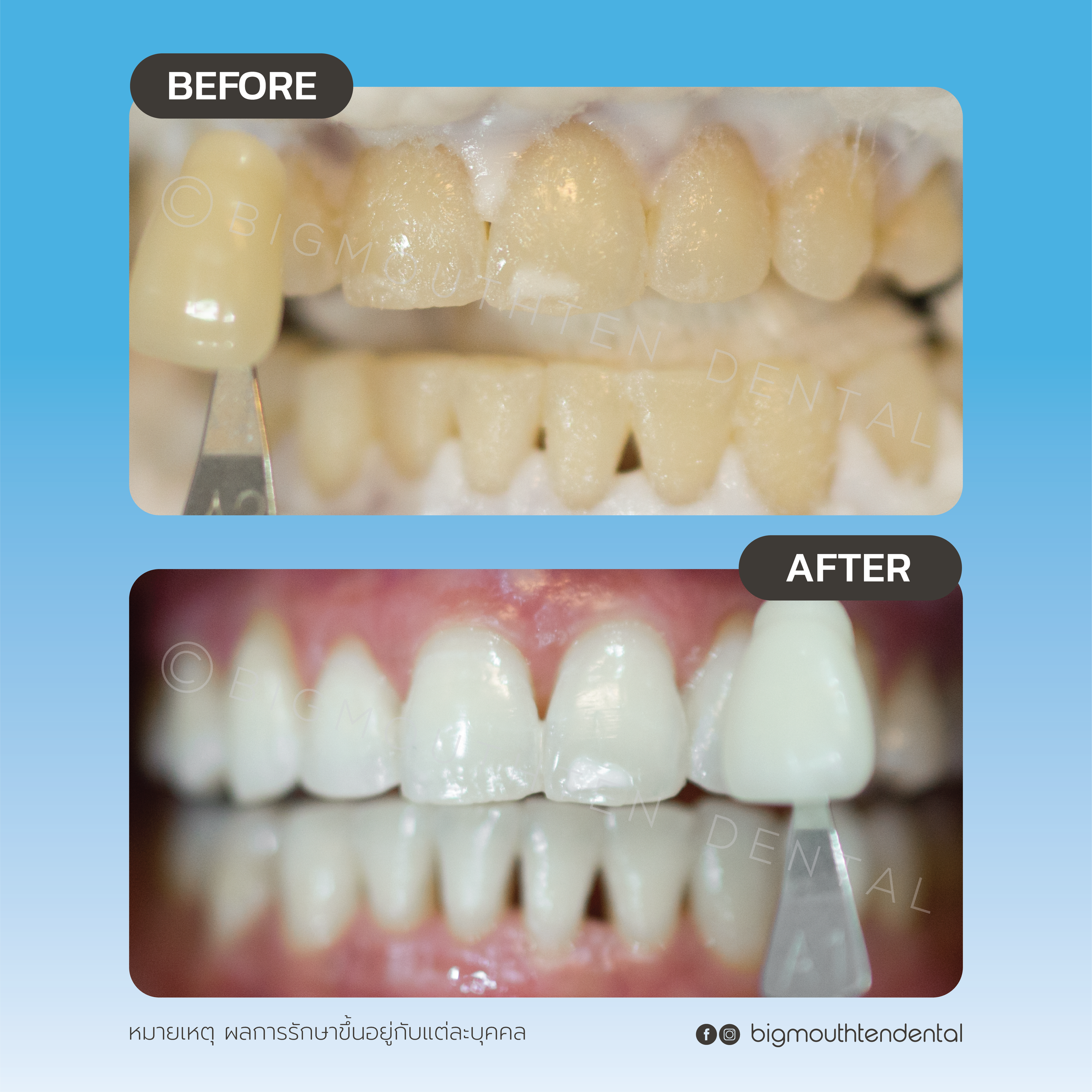 รีวิวเคสฟอกสีฟันที่คลินิก before after ฟอกสีฟัน Zoom  เชียงใหม่ 
