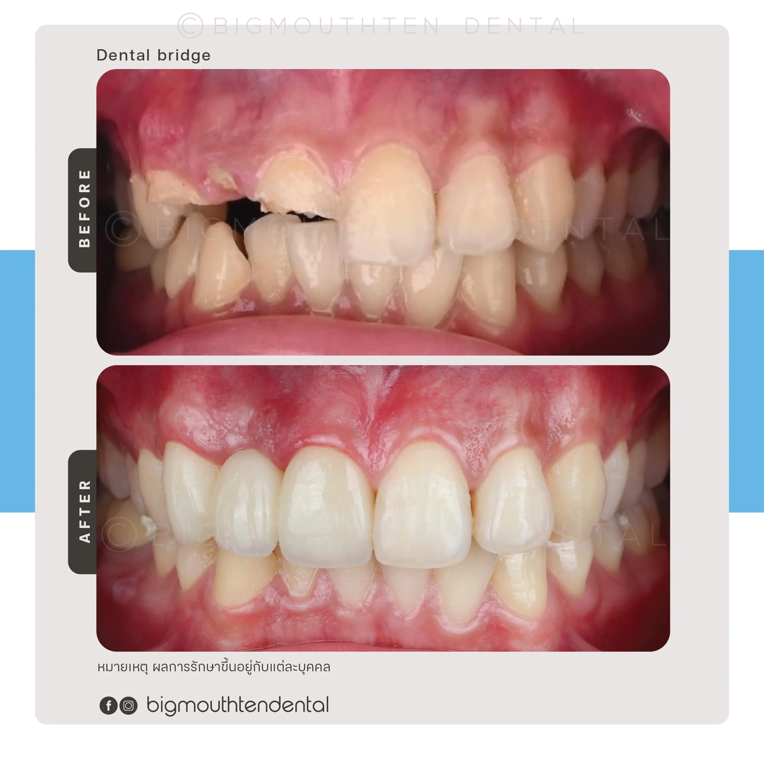 ก่อนและหลังทำสะพานฟัน – Bigmouthten ทันตกรรม เชียงใหม่