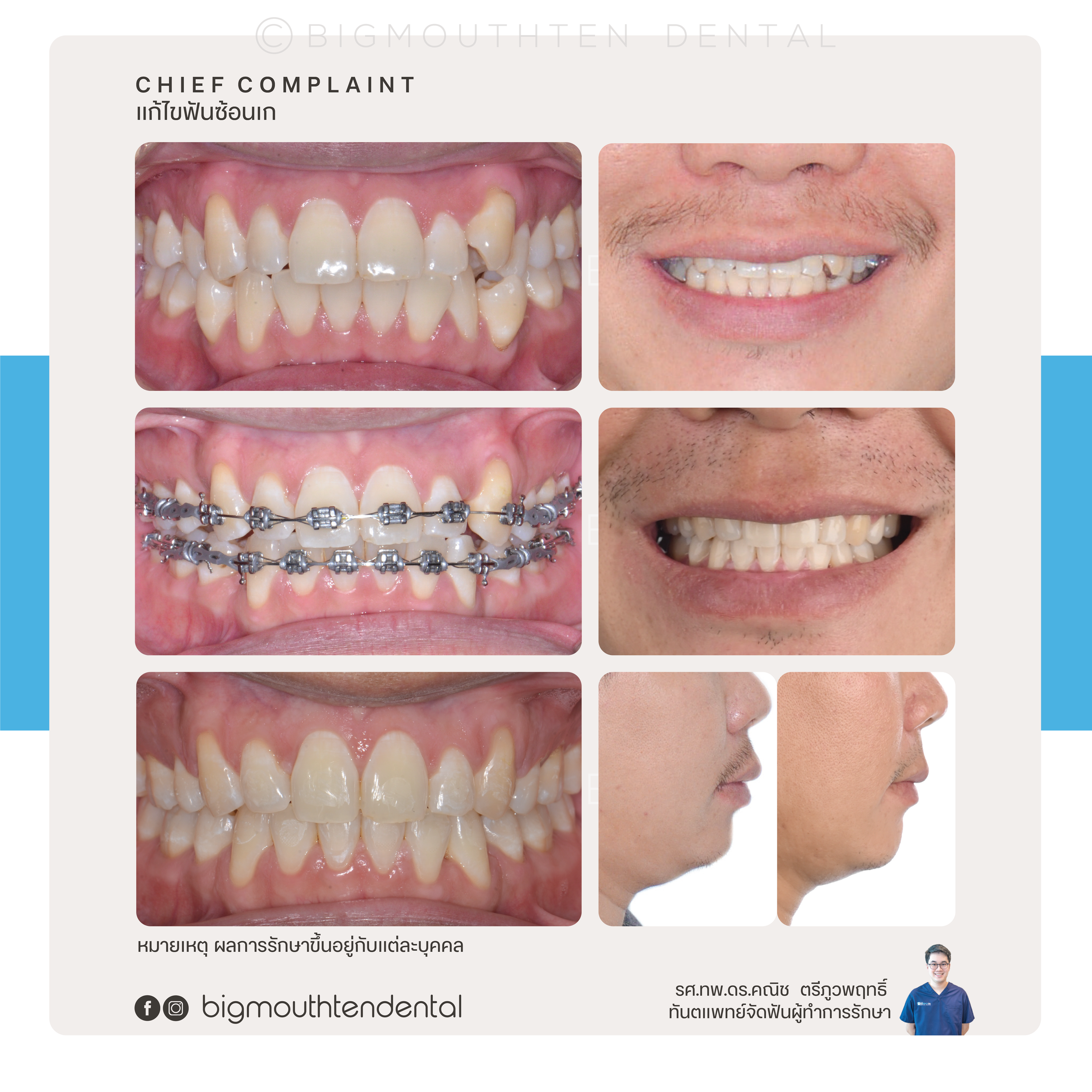 Before&After-orthodontic-braces-bigmouthten-chiangmai.png