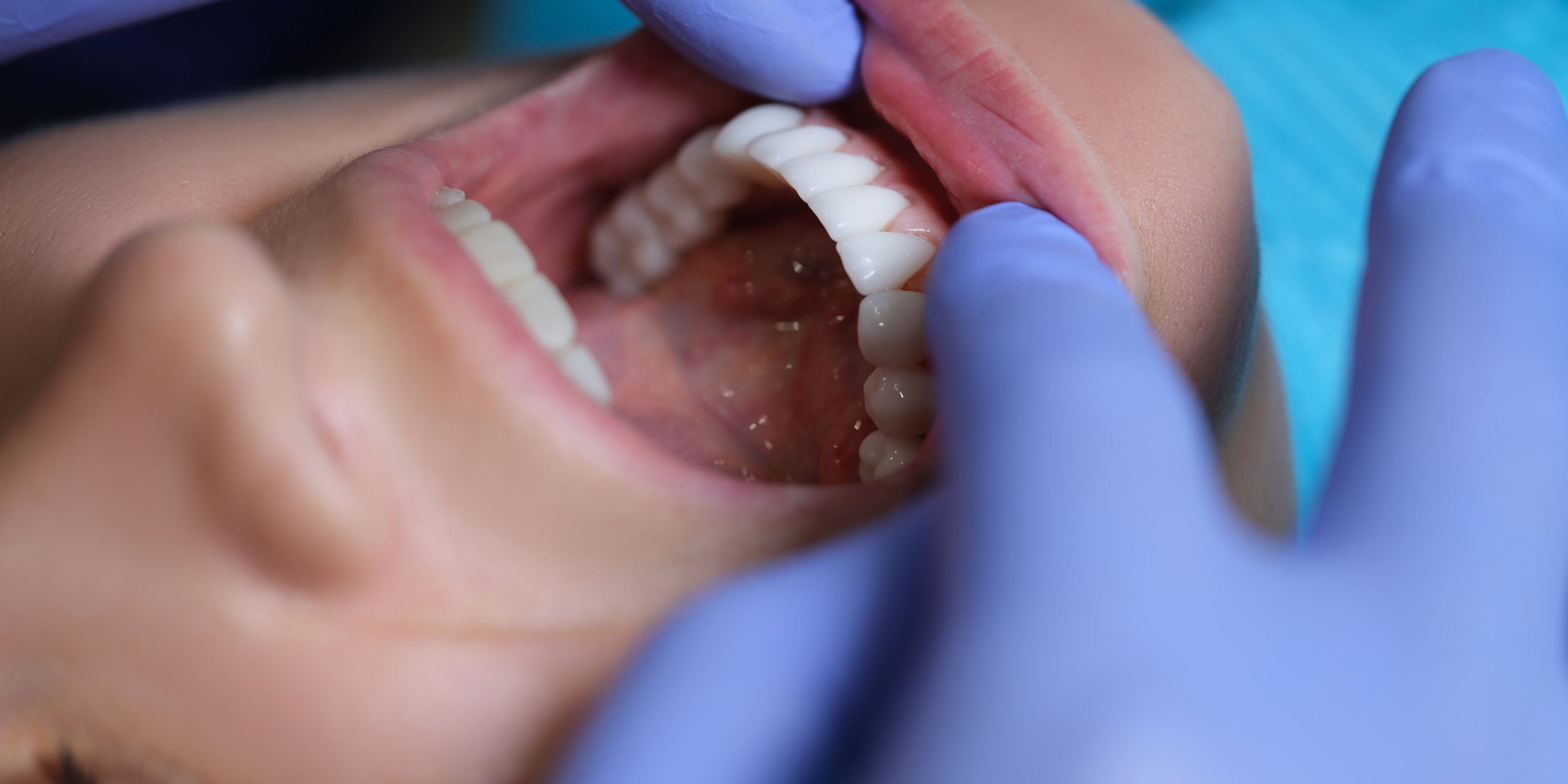 Aesthetic dental veneers for smile enhancement