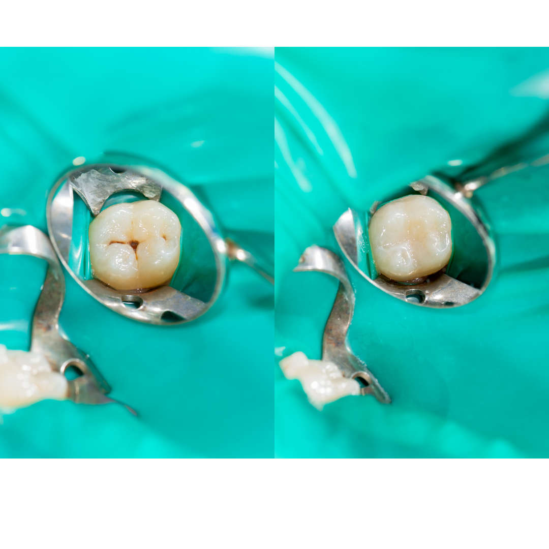 before after tooth filling | ภาพก่อนหลังอุดฟัน