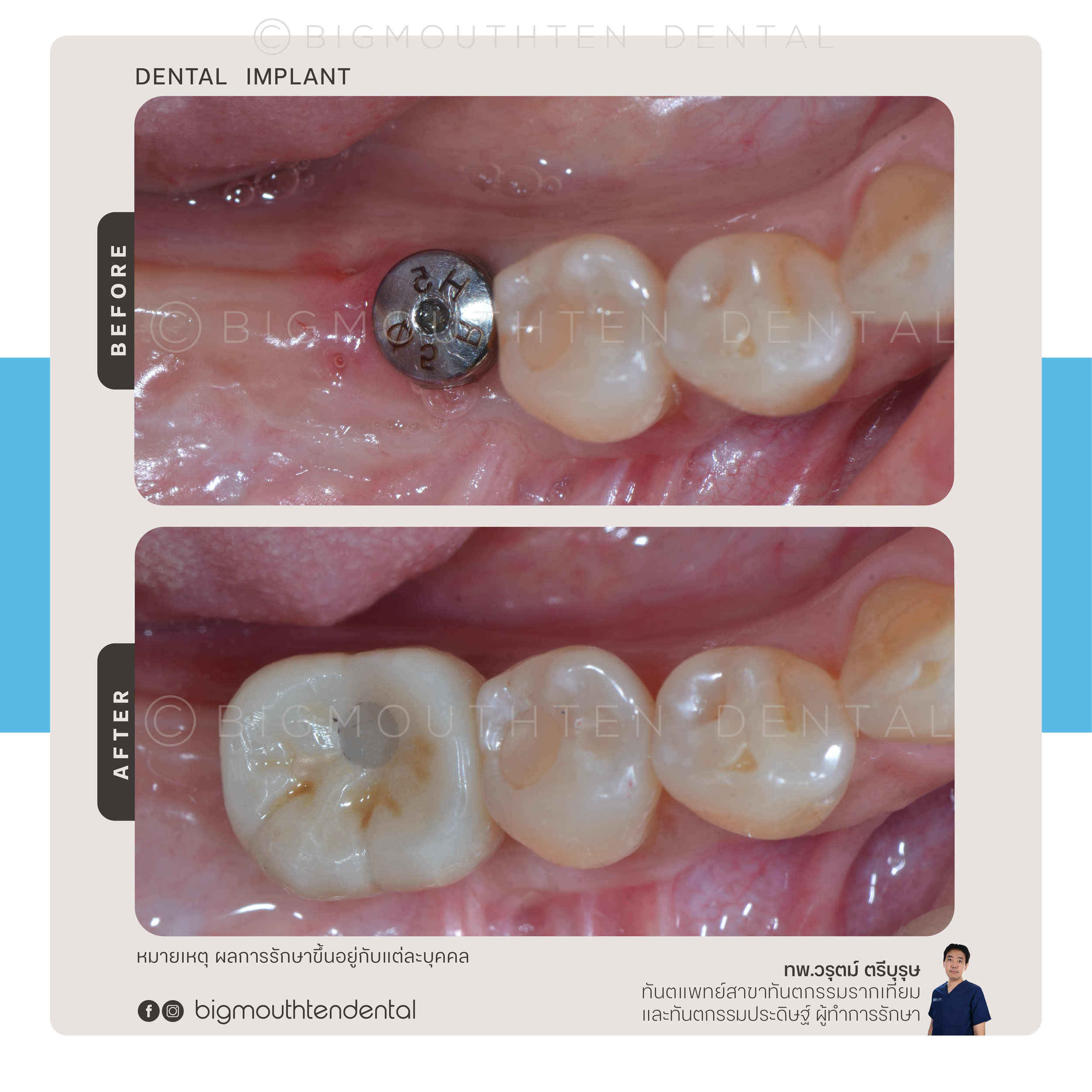 Close-up of a person's upper molars showing a dental implant with a metal post and a white dental crown, before and after treatment. The top image shows the implant with surrounding gum tissue, and the bottom image shows the completed crown restored 